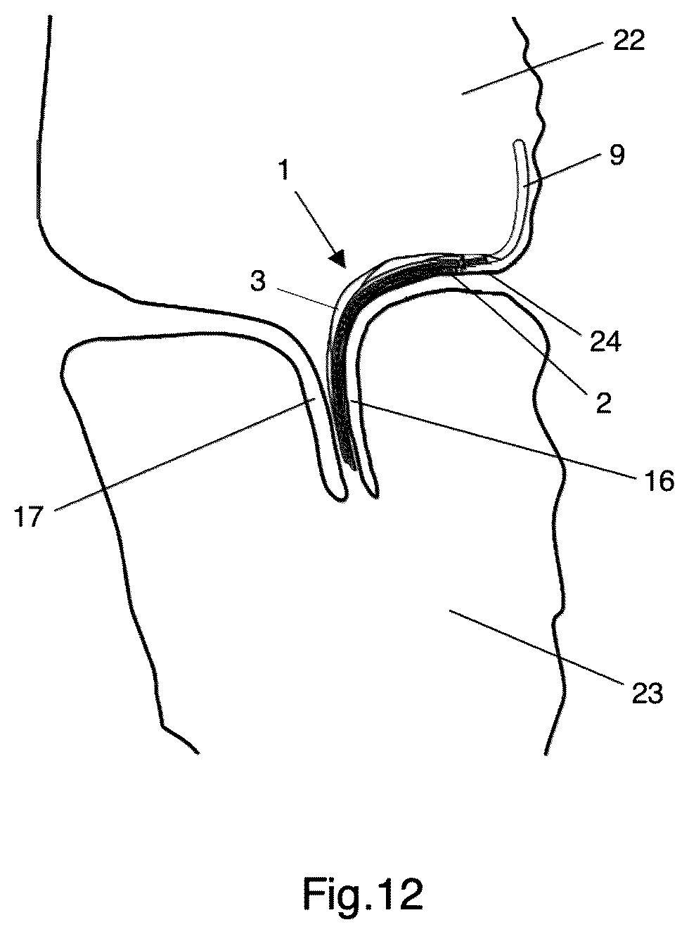 Patent US12303387 Figure 7 – Implant for improving coaptation of an atrioventricular valve
