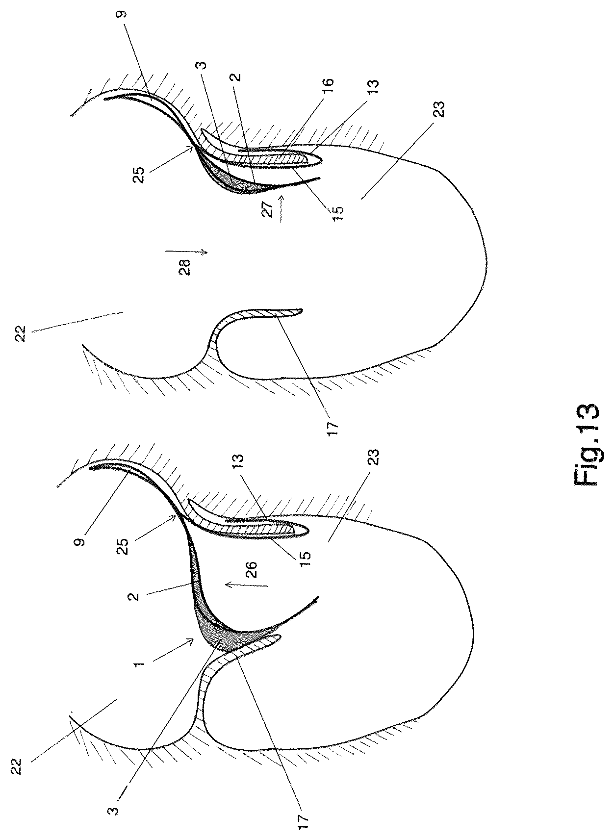 Patent US12303387 Figure 8 – Implant for improving coaptation of an atrioventricular valve