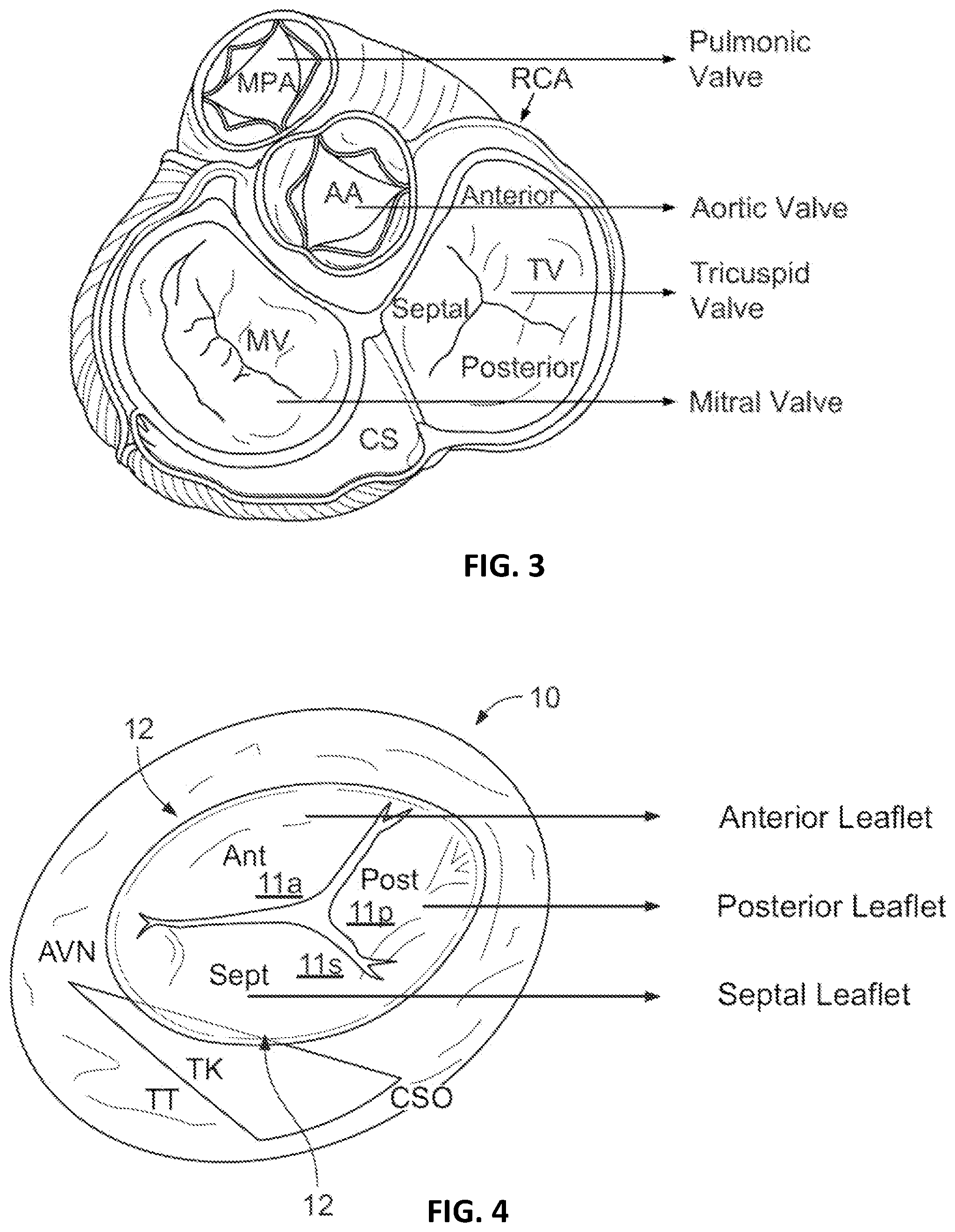 Patent US12303389 Figure 2 – Prosthetic heart valves