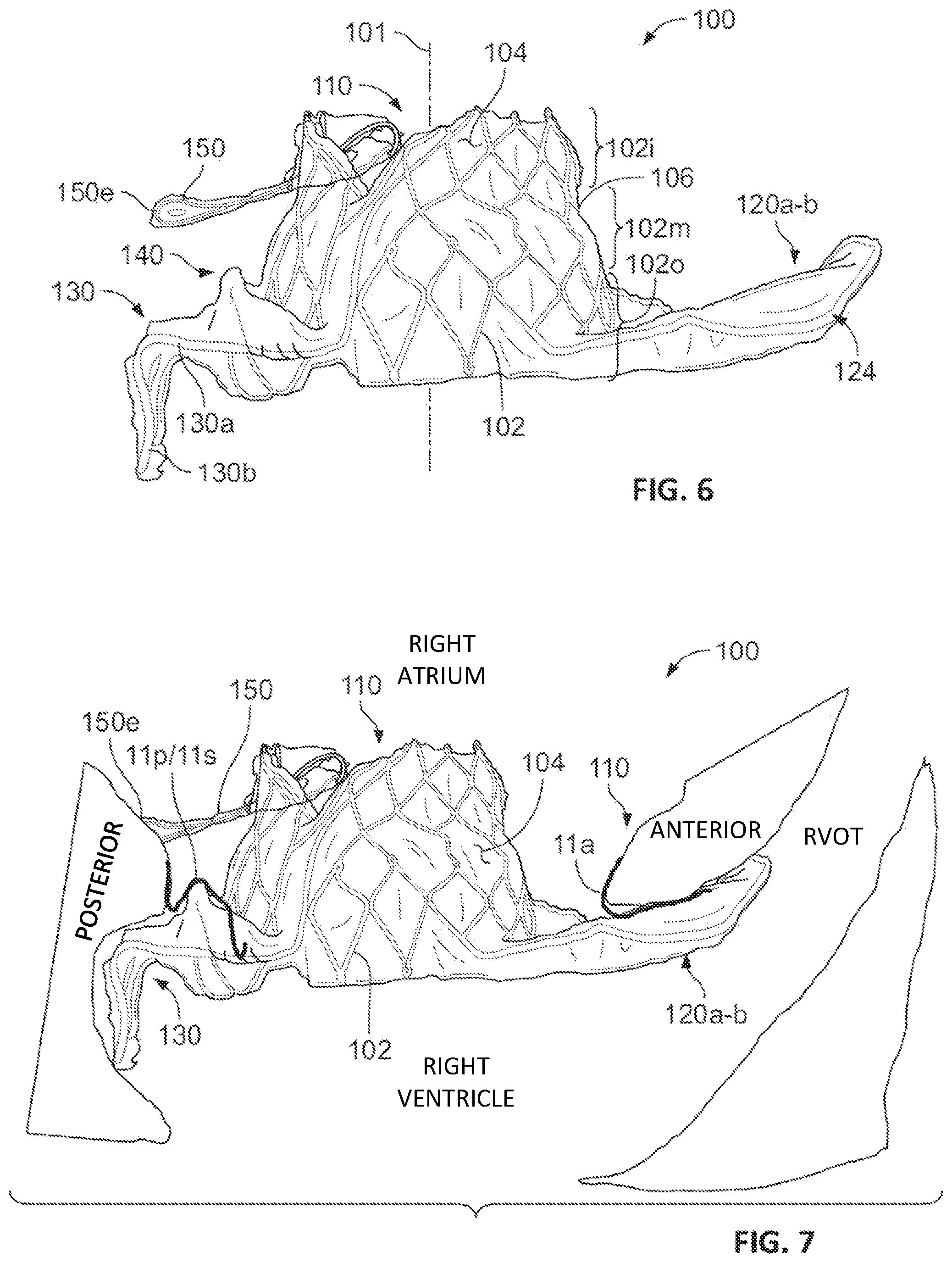 Patent US12303389 Figure 4 – Prosthetic heart valves