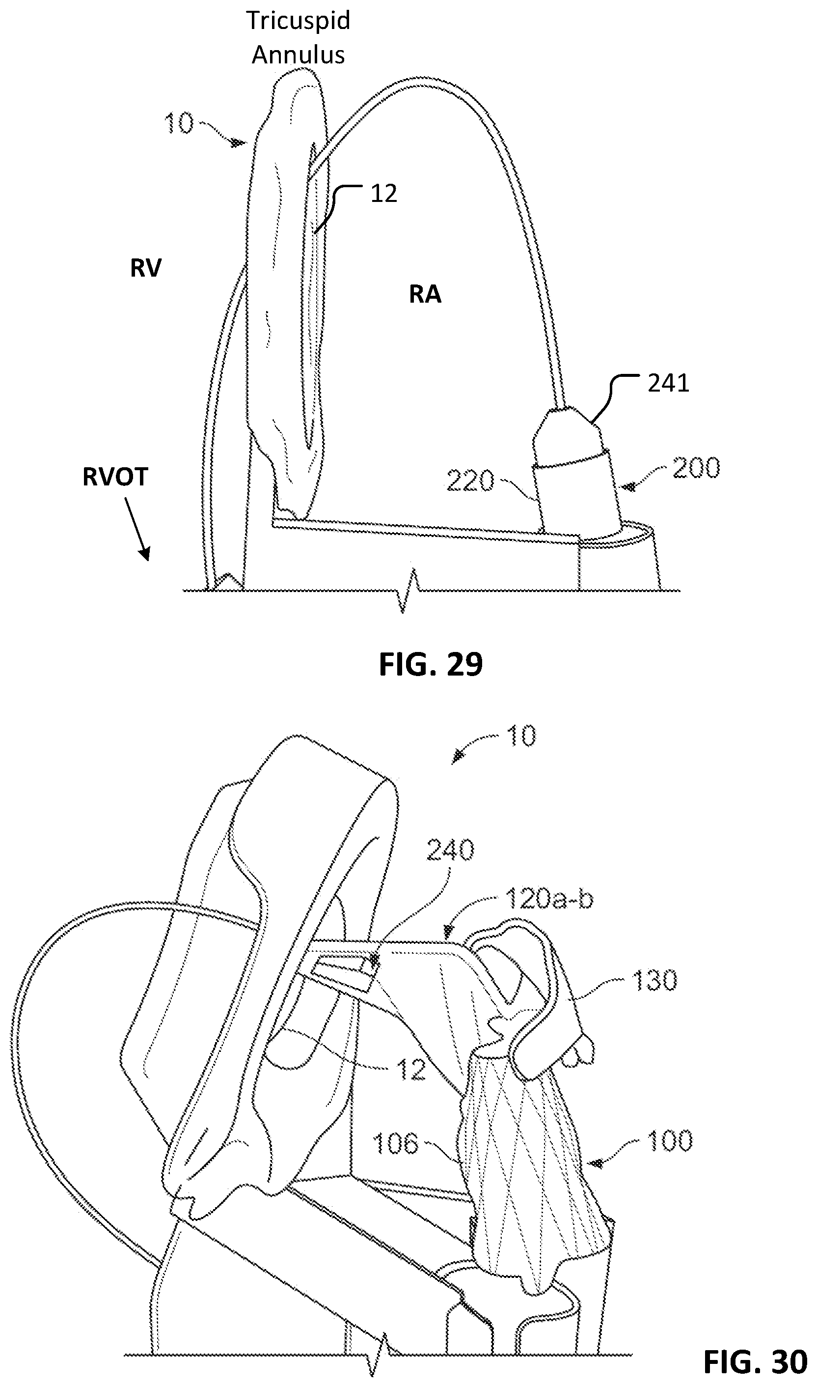 Patent US12303389 Figure 14 – Prosthetic heart valves
