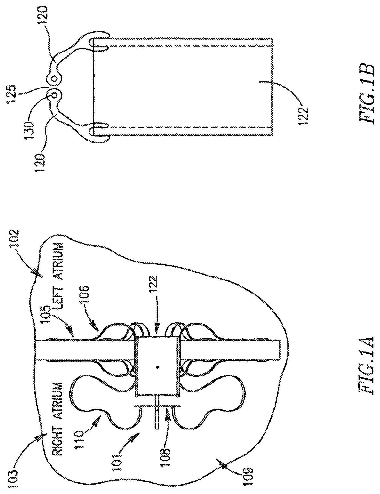 Patent US12303390 Figure 1 – Device and method for controlling in-vivo pressure