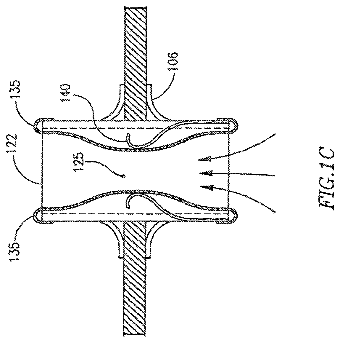 Patent US12303390 Figure 2 – Device and method for controlling in-vivo pressure
