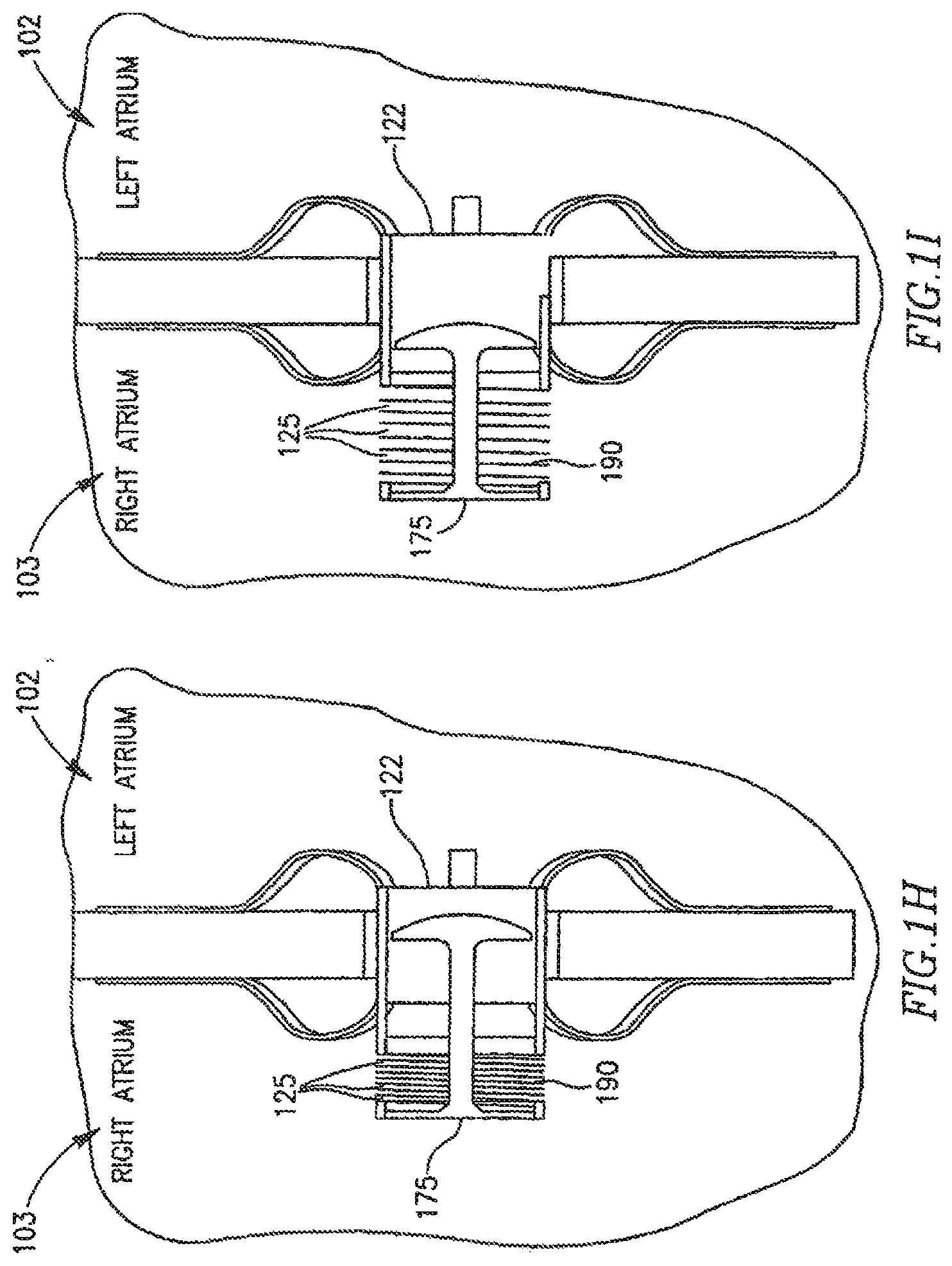 Patent US12303390 Figure 5 – Device and method for controlling in-vivo pressure