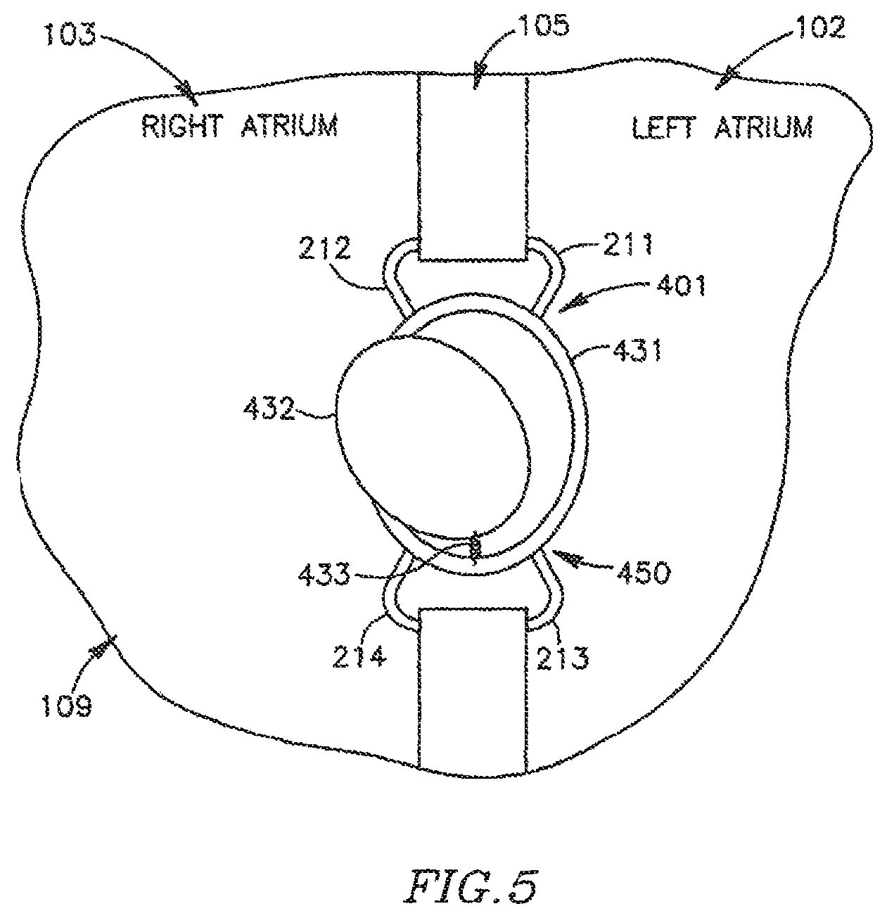 Patent US12303390 Figure 10 – Device and method for controlling in-vivo pressure