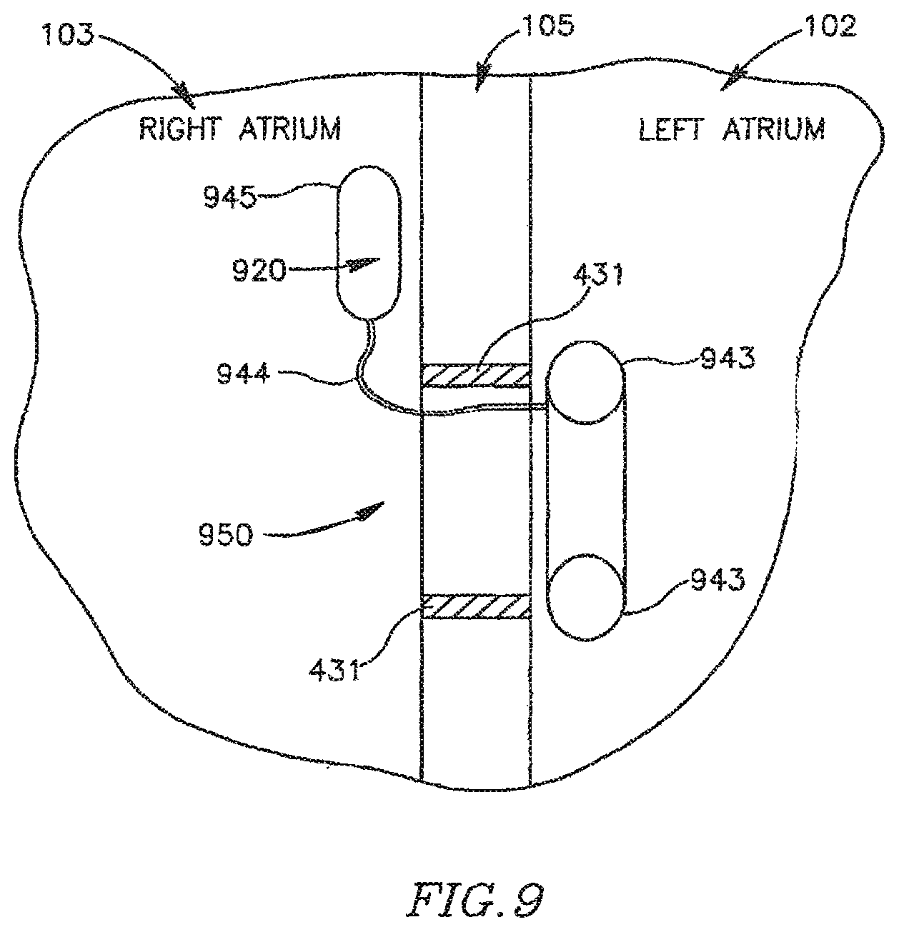 Patent US12303390 Figure 13 – Device and method for controlling in-vivo pressure