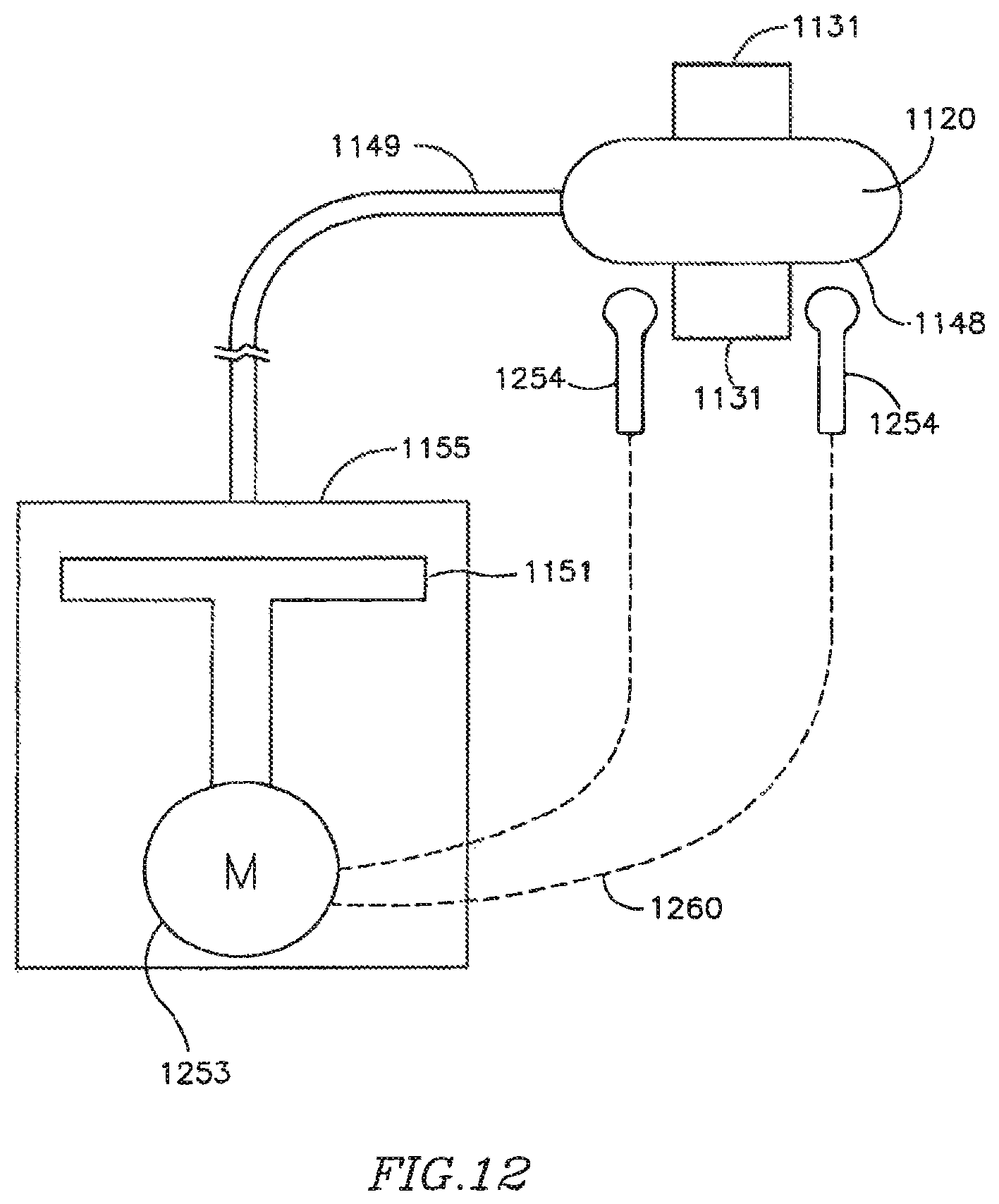 Patent US12303390 Figure 16 – Device and method for controlling in-vivo pressure