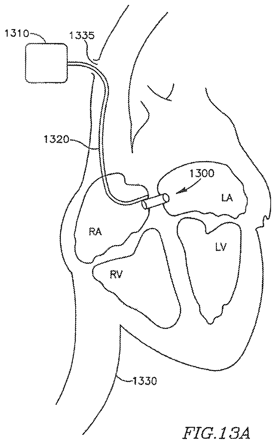 Patent US12303390 Figure 17 – Device and method for controlling in-vivo pressure