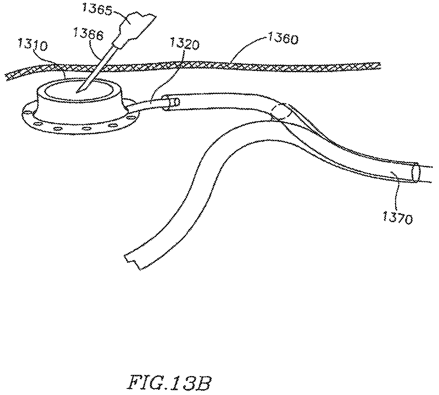 Patent US12303390 Figure 18 – Device and method for controlling in-vivo pressure