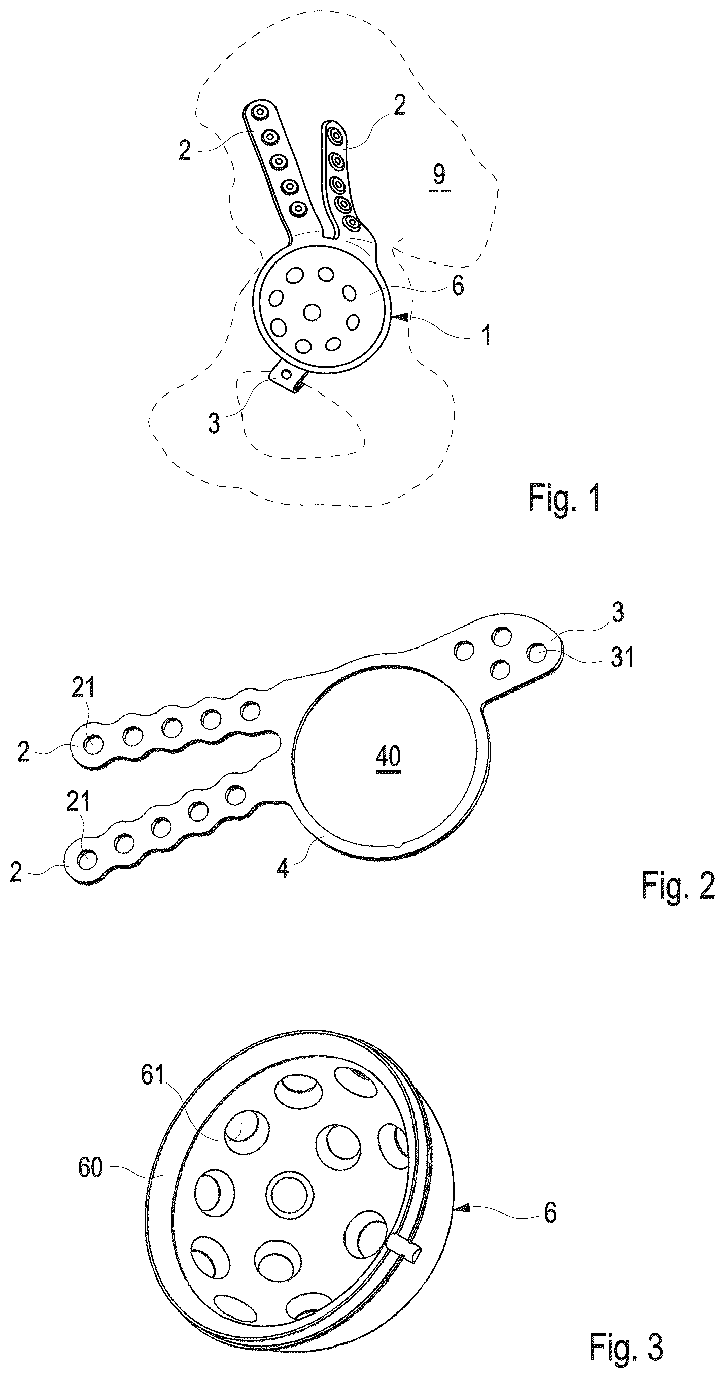 Patent US12303391 Figure 1 – Hip joint implant with reshapeable fastening brackets
