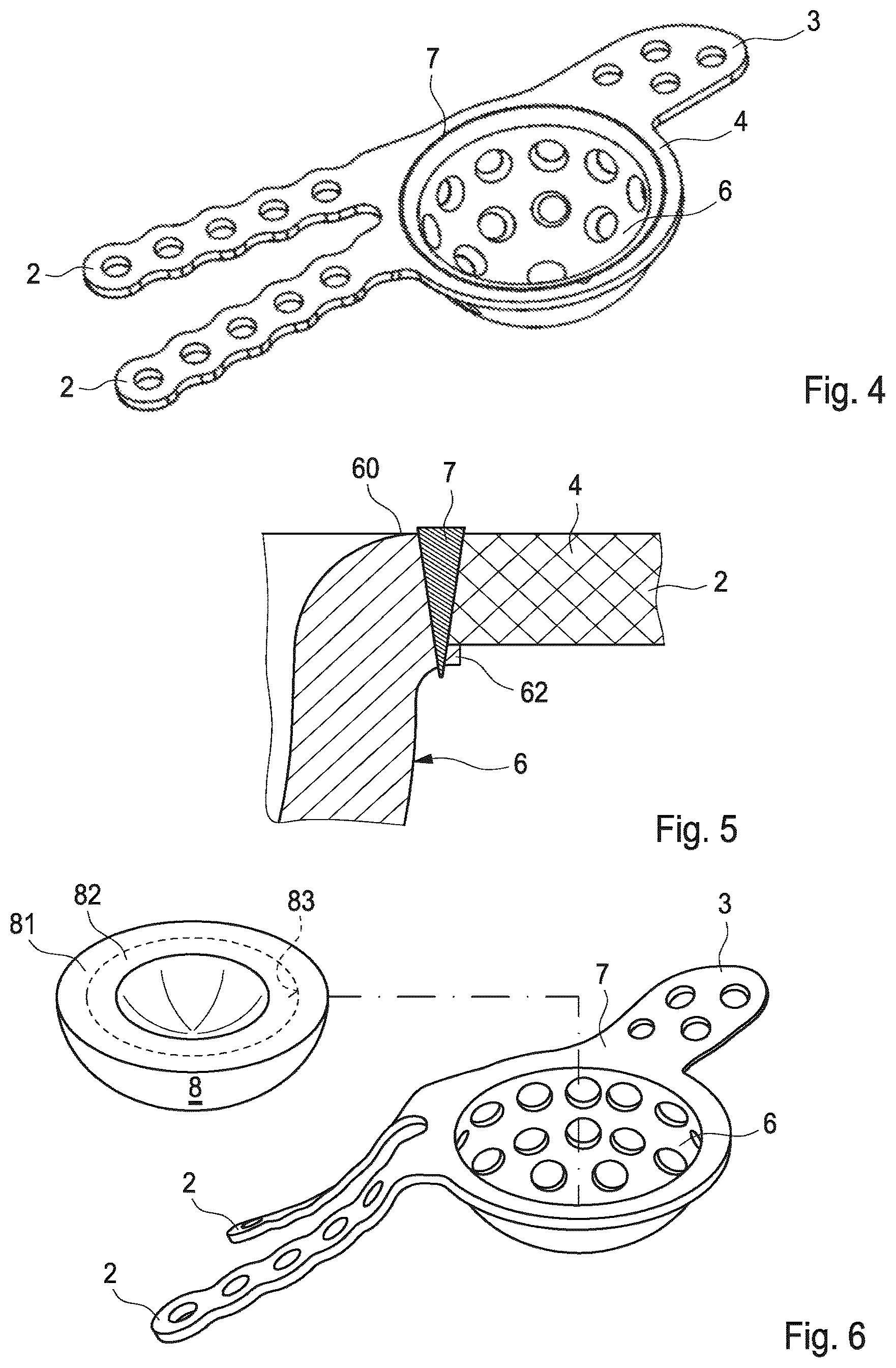 Patent US12303391 Figure 2 – Hip joint implant with reshapeable fastening brackets