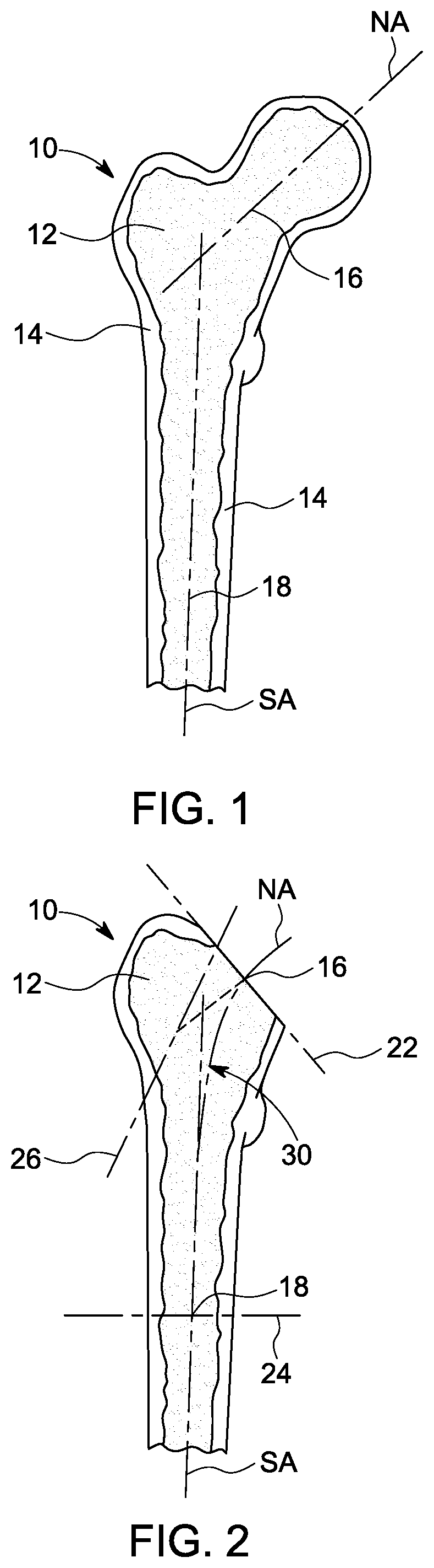 Patent US12303393 — Custom hip design and insertability analysis — Figure 1