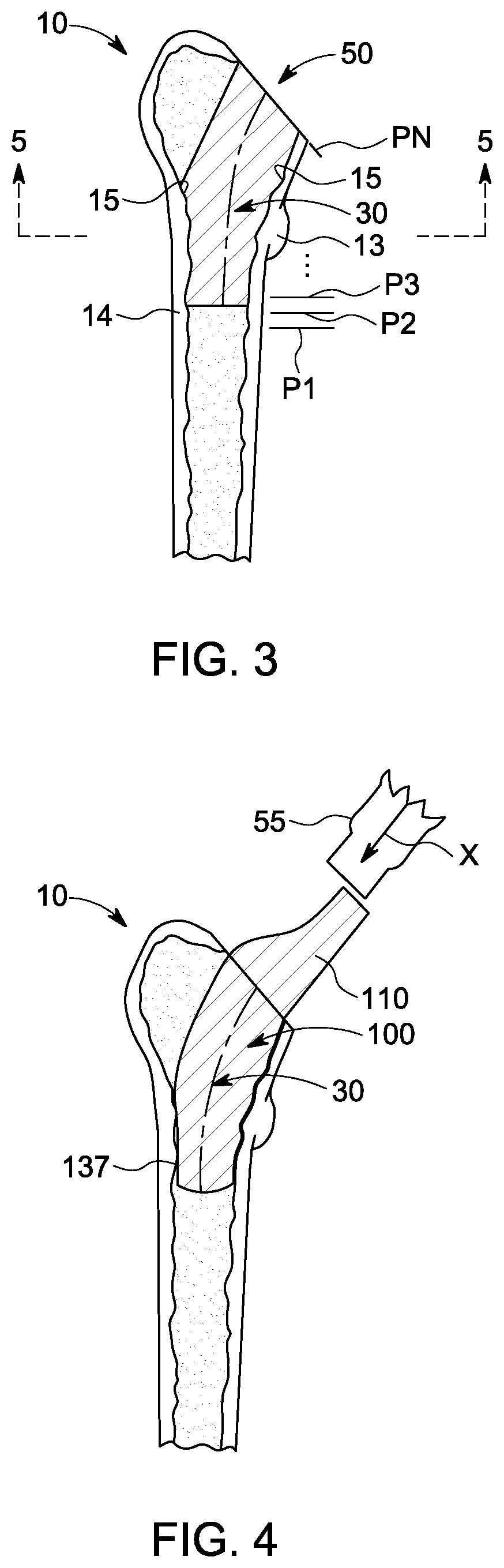 Patent US12303393 Figure 2 – Custom hip design and insertability analysis