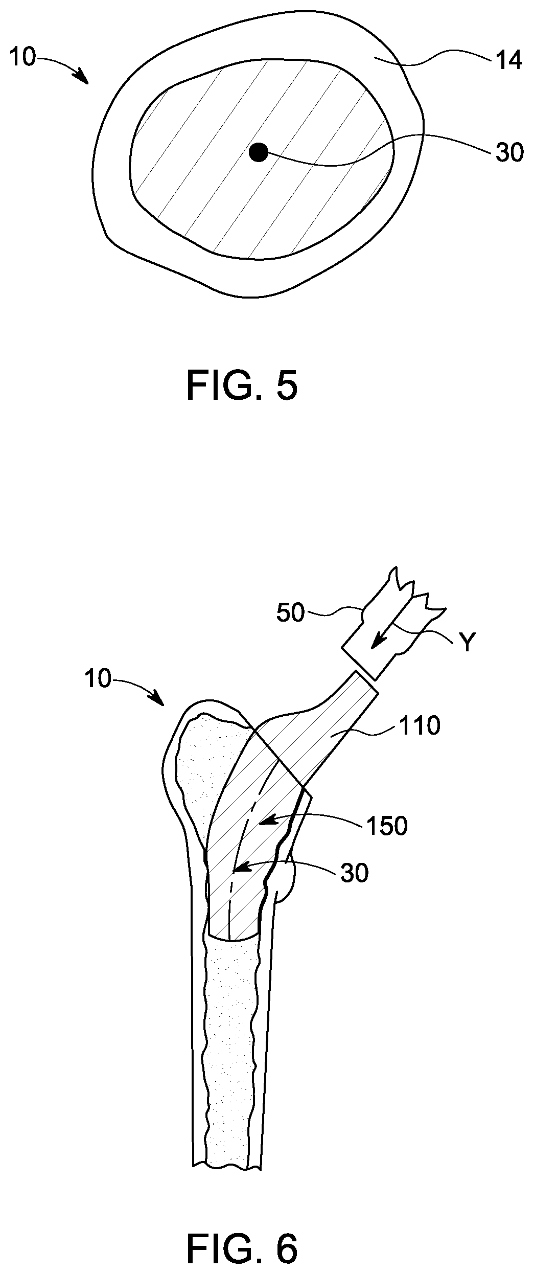Patent US12303393 Figure 3 – Custom hip design and insertability analysis