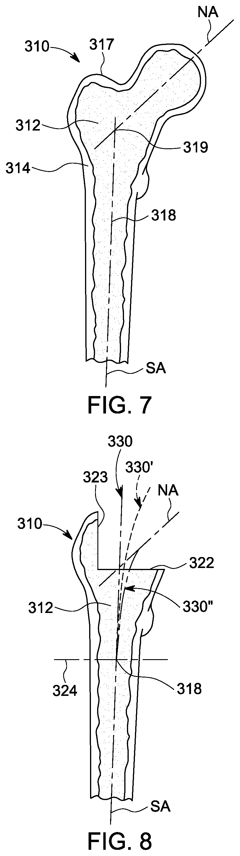 Patent US12303393 Figure 4 – Custom hip design and insertability analysis