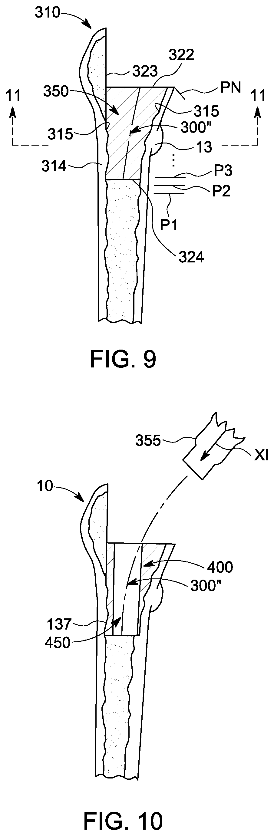 Patent US12303393 Figure 5 – Custom hip design and insertability analysis