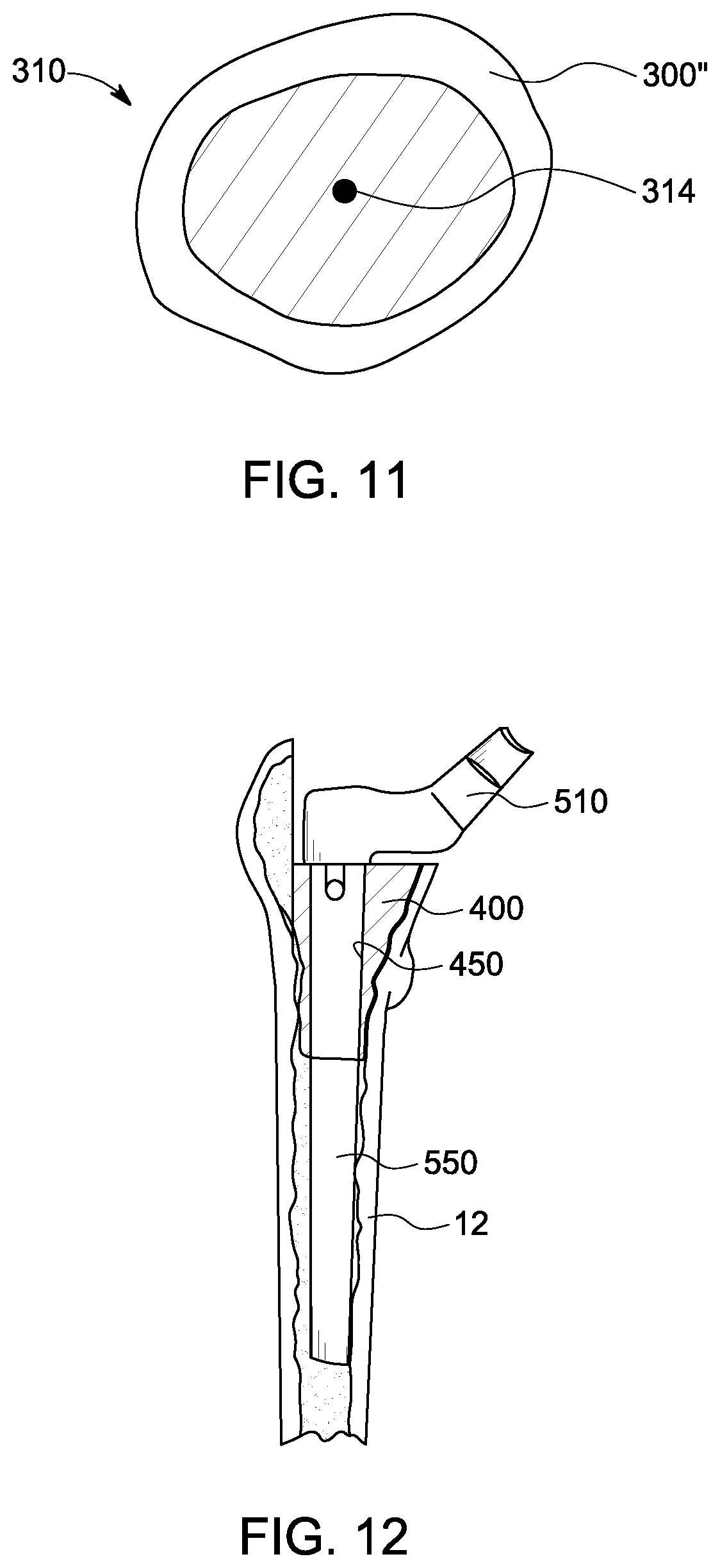 Patent US12303393 Figure 6 – Custom hip design and insertability analysis