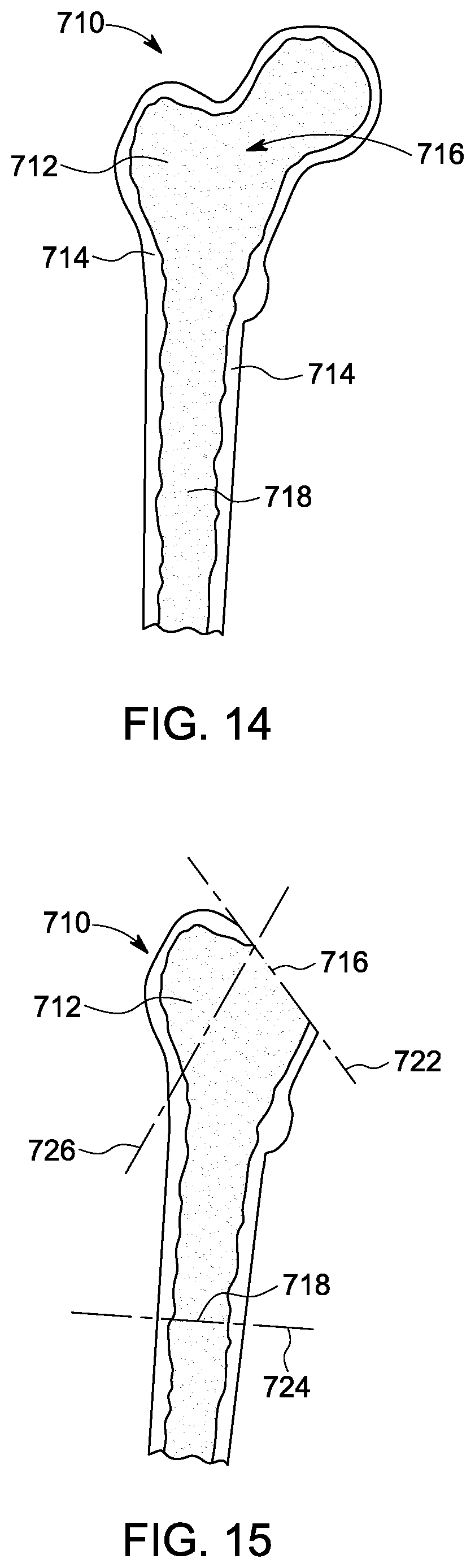 Patent US12303393 Figure 8 – Custom hip design and insertability analysis