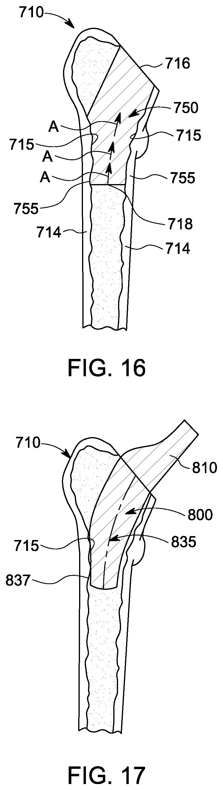 Patent US12303393 Figure 9 – Custom hip design and insertability analysis