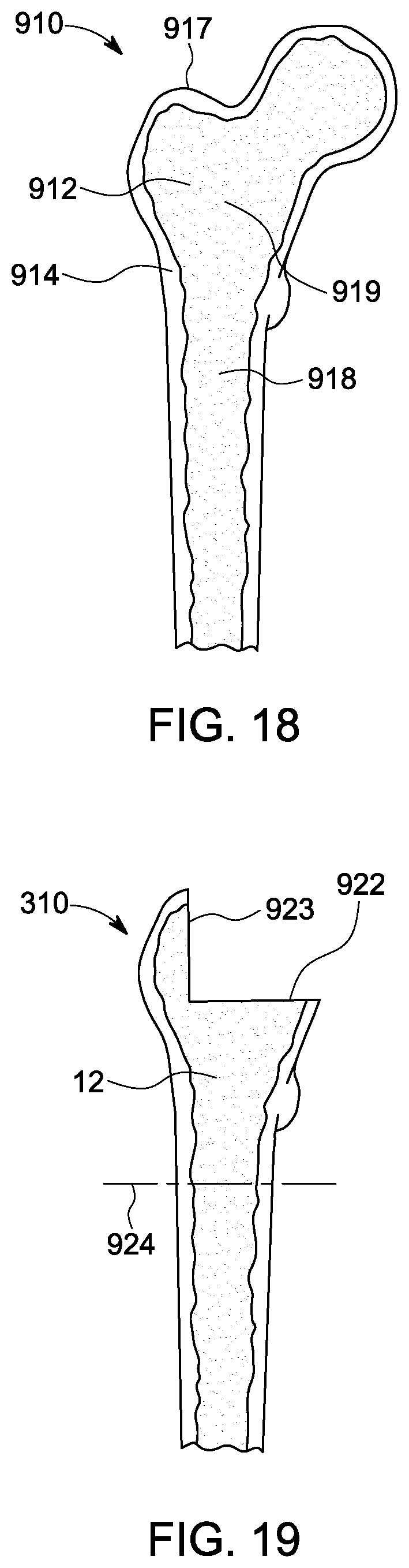 Patent US12303393 Figure 10 – Custom hip design and insertability analysis