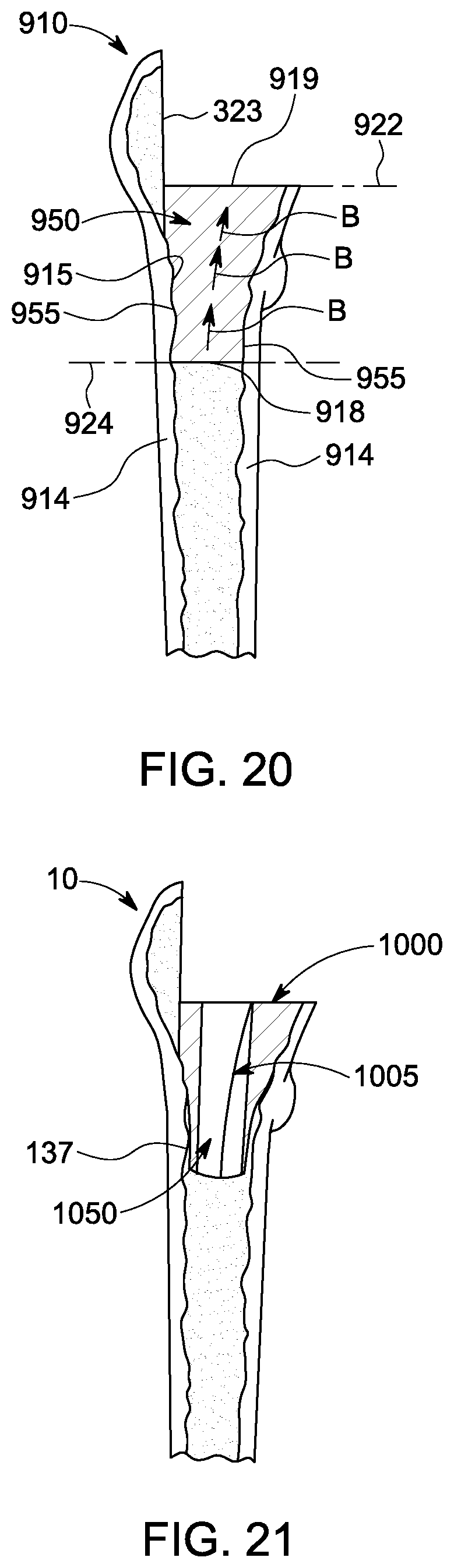 Patent US12303393 Figure 11 – Custom hip design and insertability analysis