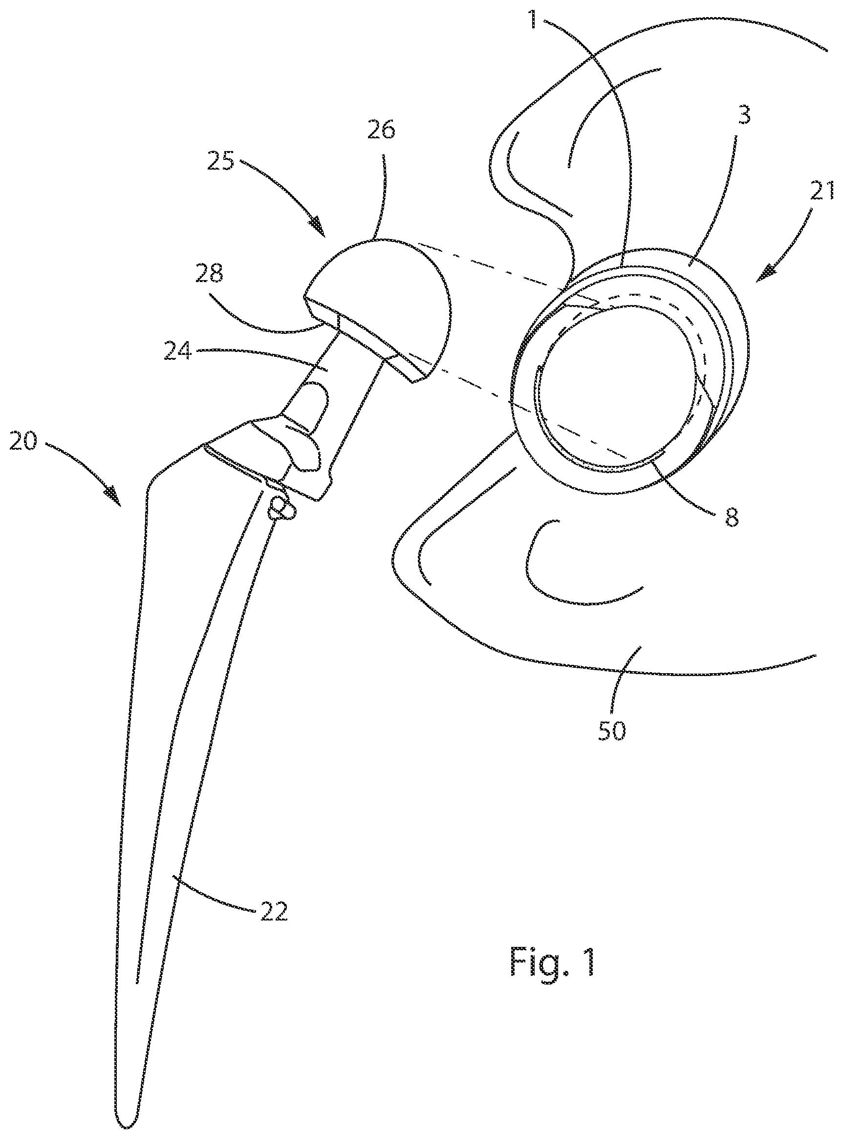 Patent US12303394 Figure 1 – Constrained acetabular liner