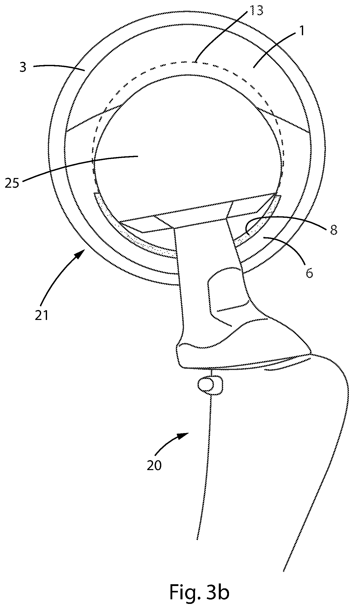 Patent US12303394 Figure 6 – Constrained acetabular liner