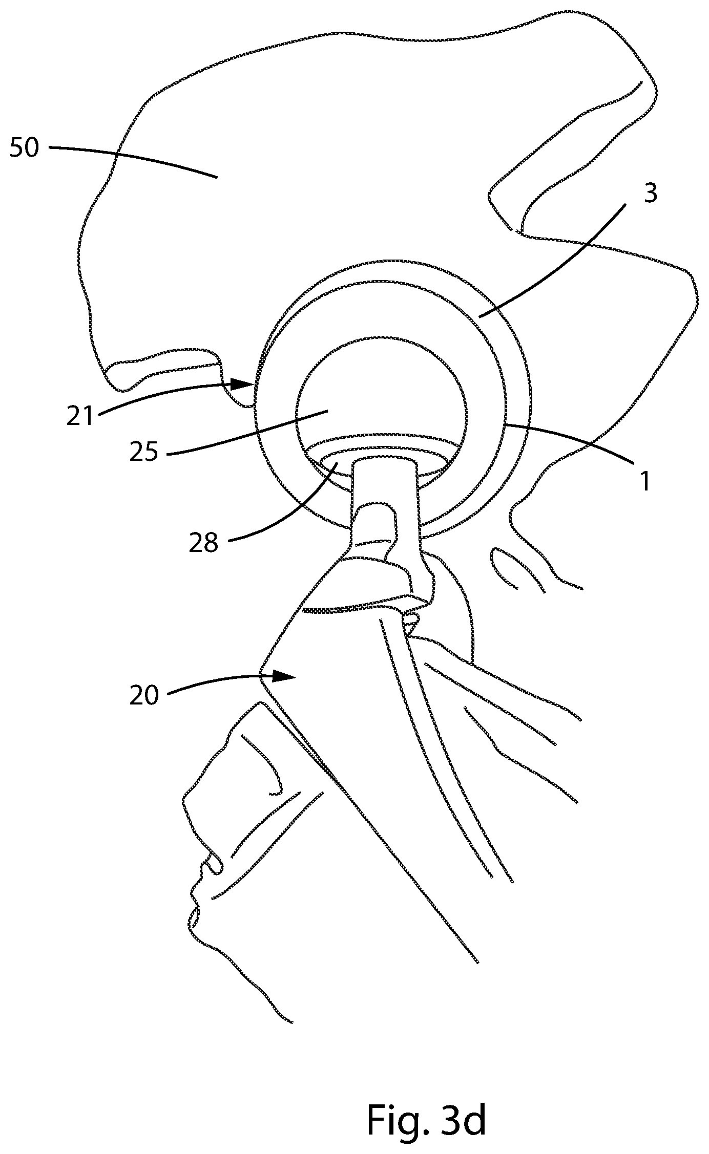 Patent US12303394 Figure 8 – Constrained acetabular liner