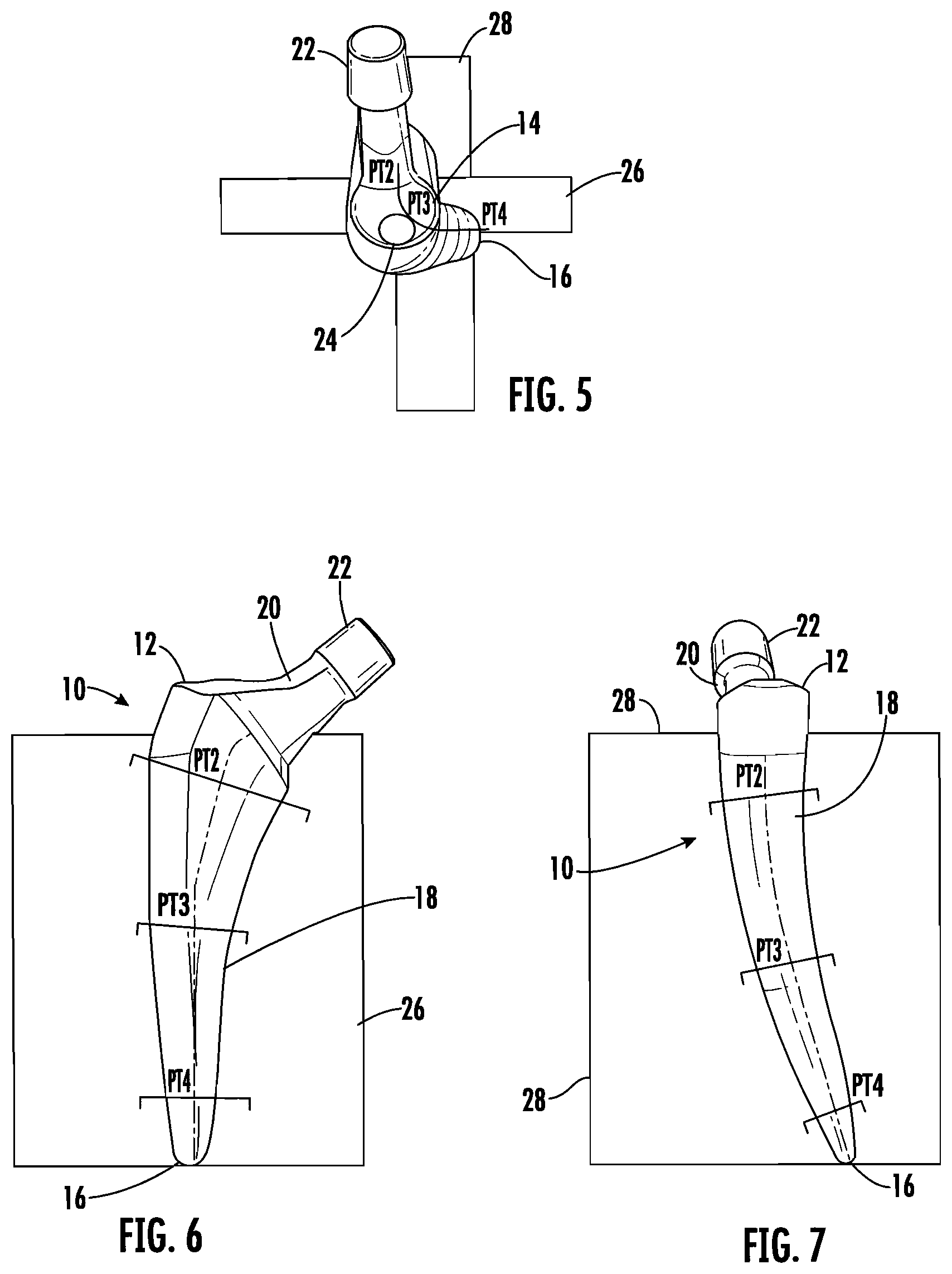 Patent US12303395 Figure 2 – Hip implant