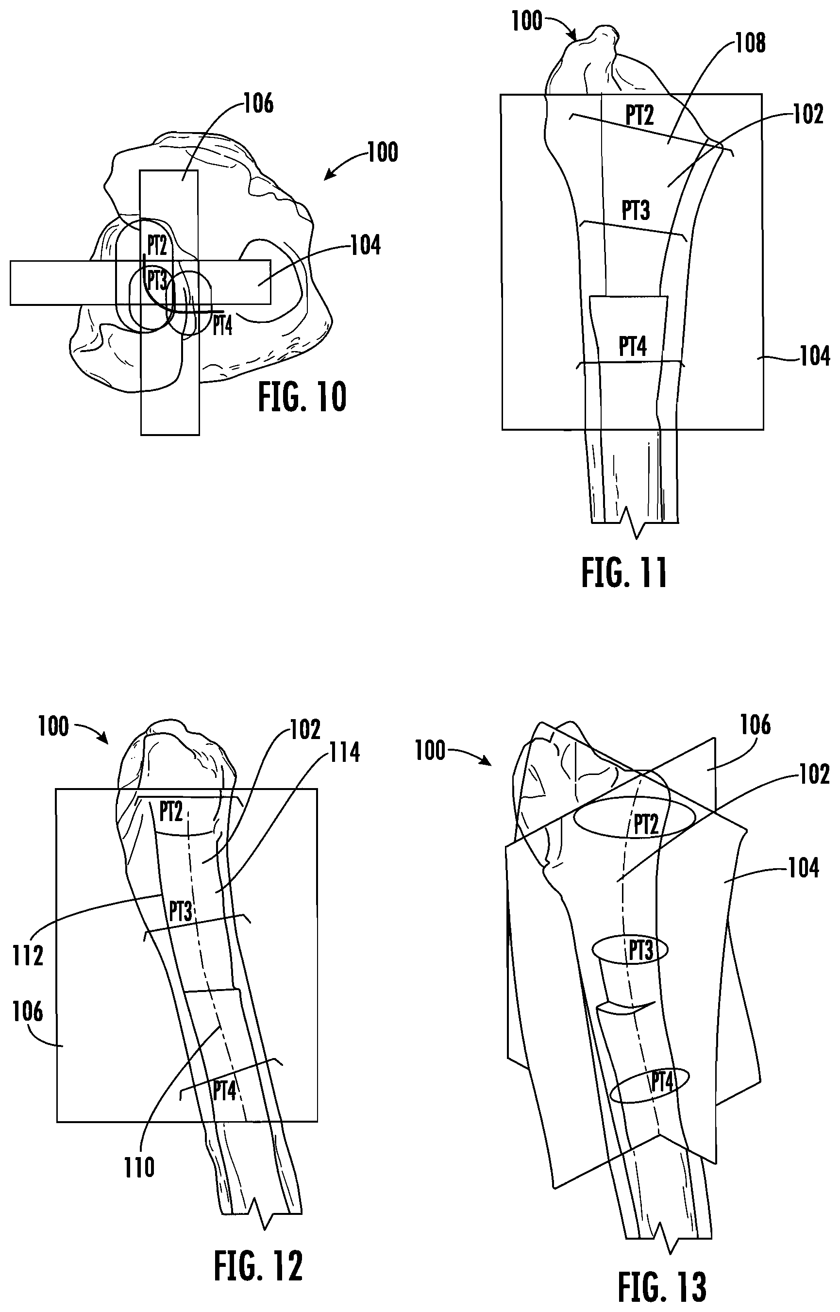 Patent US12303395 Figure 4 – Hip implant