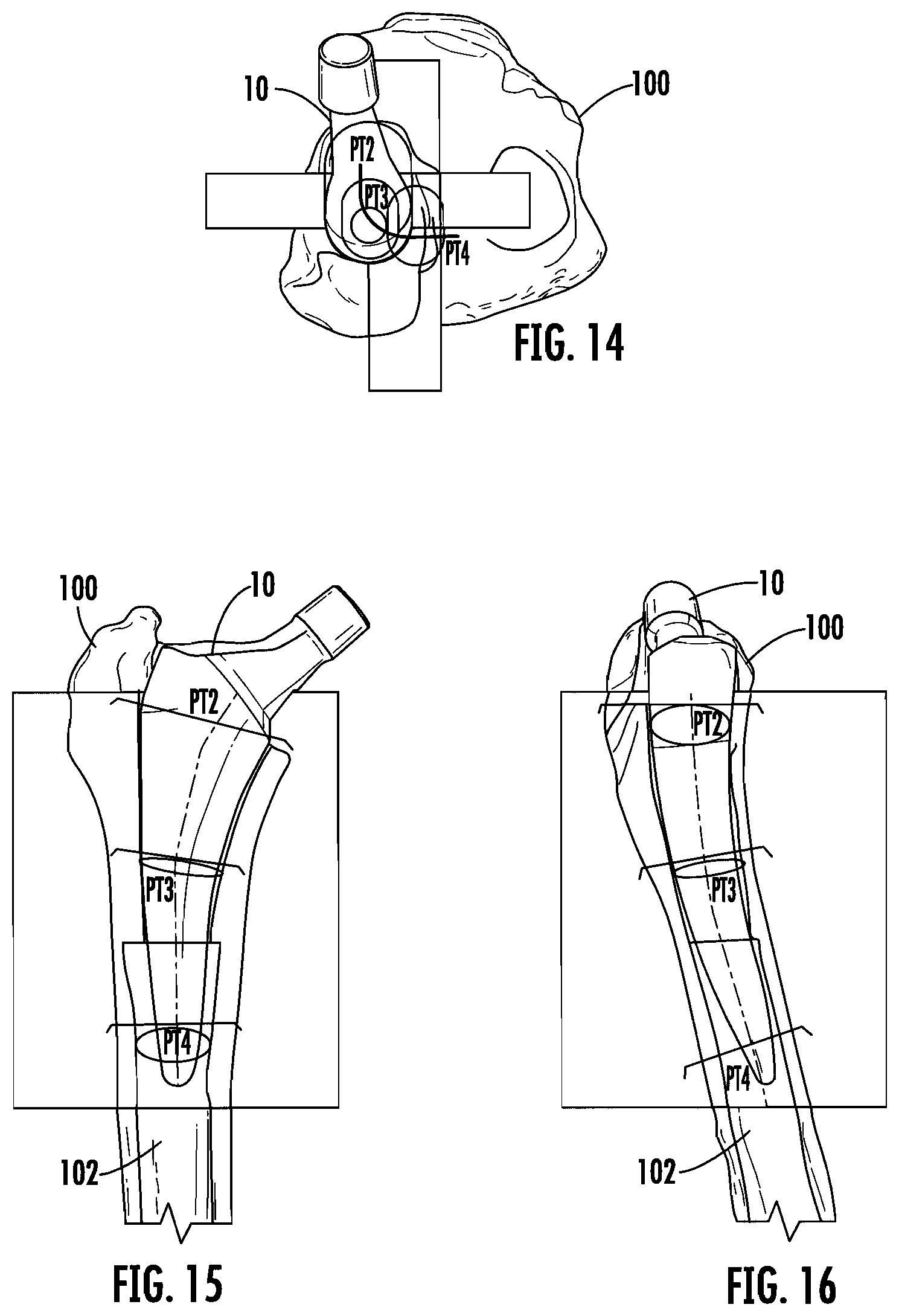 Patent US12303395 Figure 5 – Hip implant