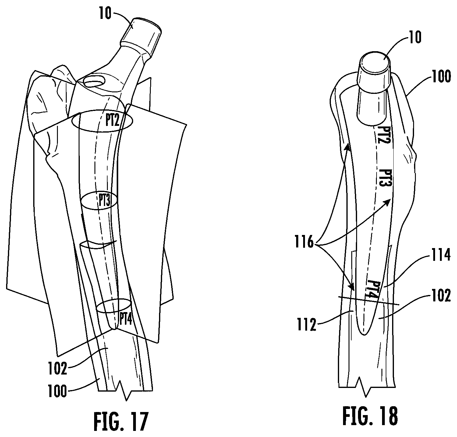 Patent US12303395 Figure 6 – Hip implant
