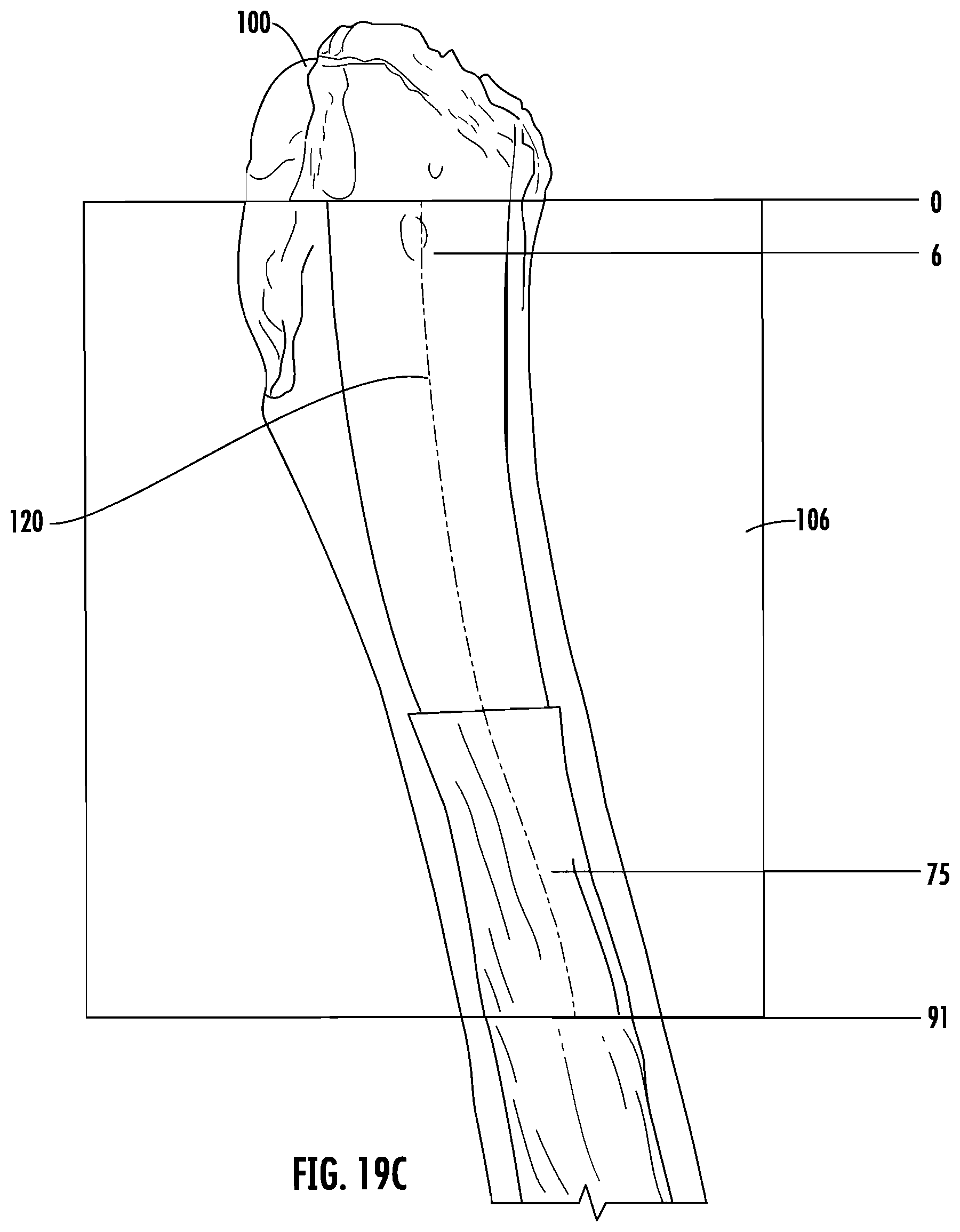 Patent US12303395 Figure 9 – Hip implant