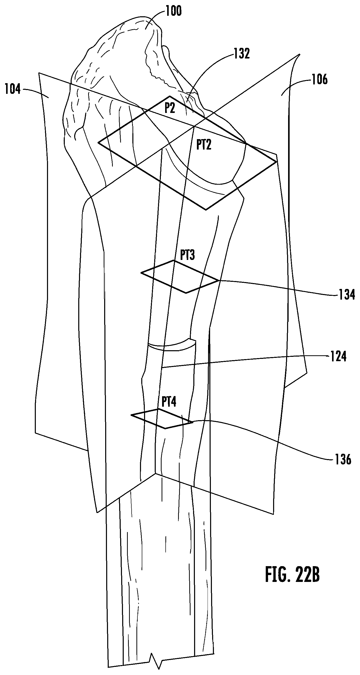 Patent US12303395 Figure 17 – Hip implant