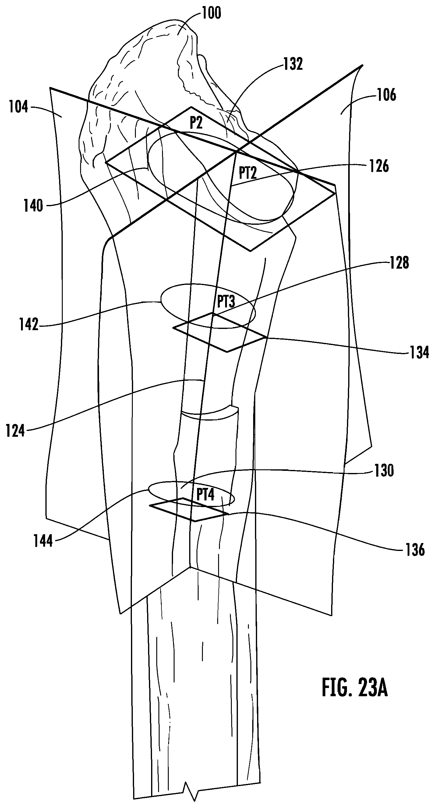 Patent US12303395 Figure 18 – Hip implant
