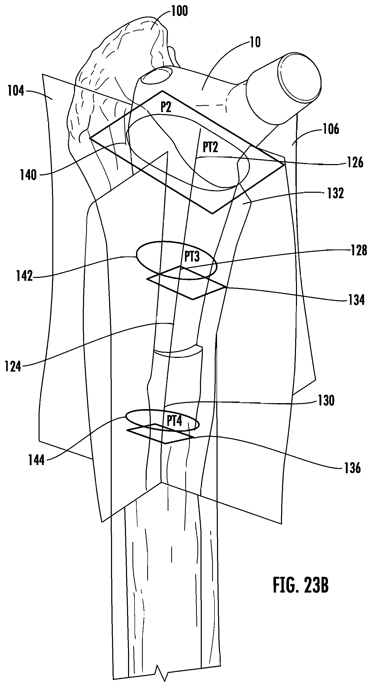 Patent US12303395 Figure 19 – Hip implant