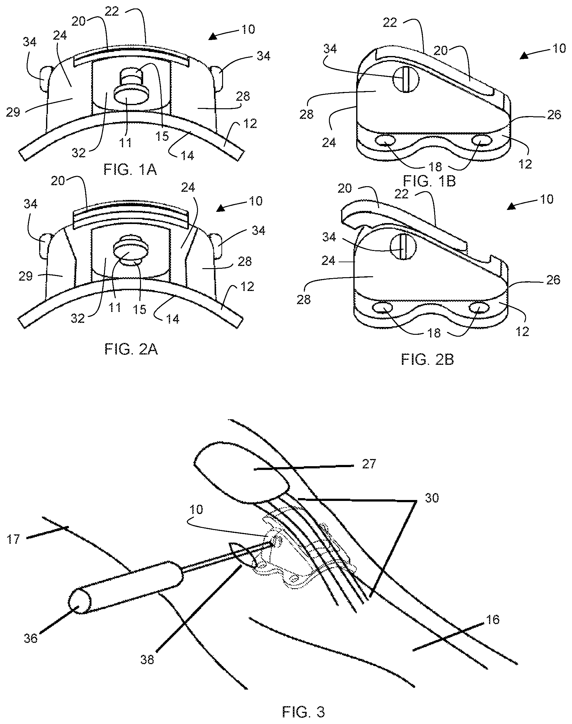 Patent US12303396 — Adjustable patellar tendon realignment implant — Figure 1