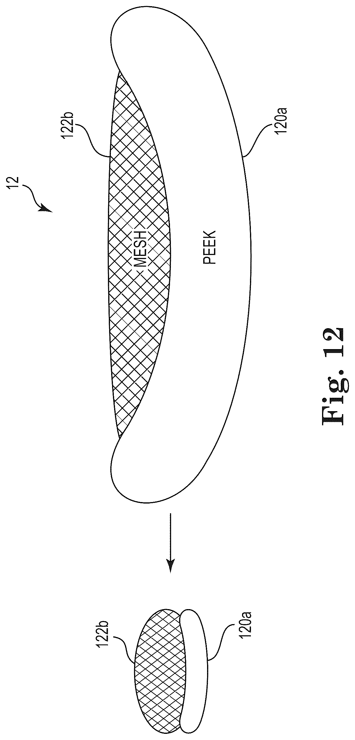 Patent US12303397 Figure 3 – Mesh spacer hybrid