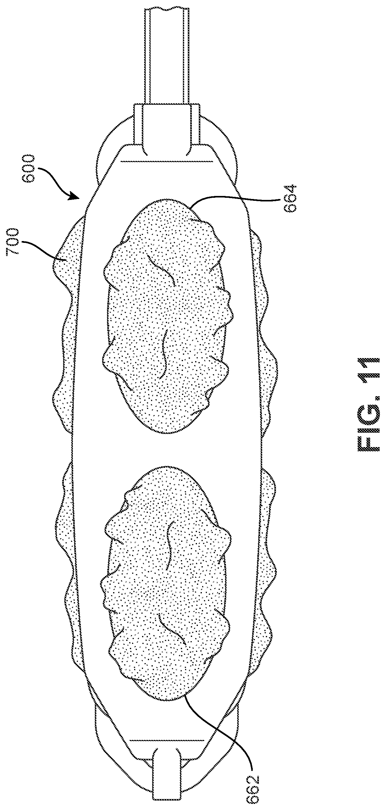 Patent US12303400 Figure 10 – Implant with structural members arranged around a ring
