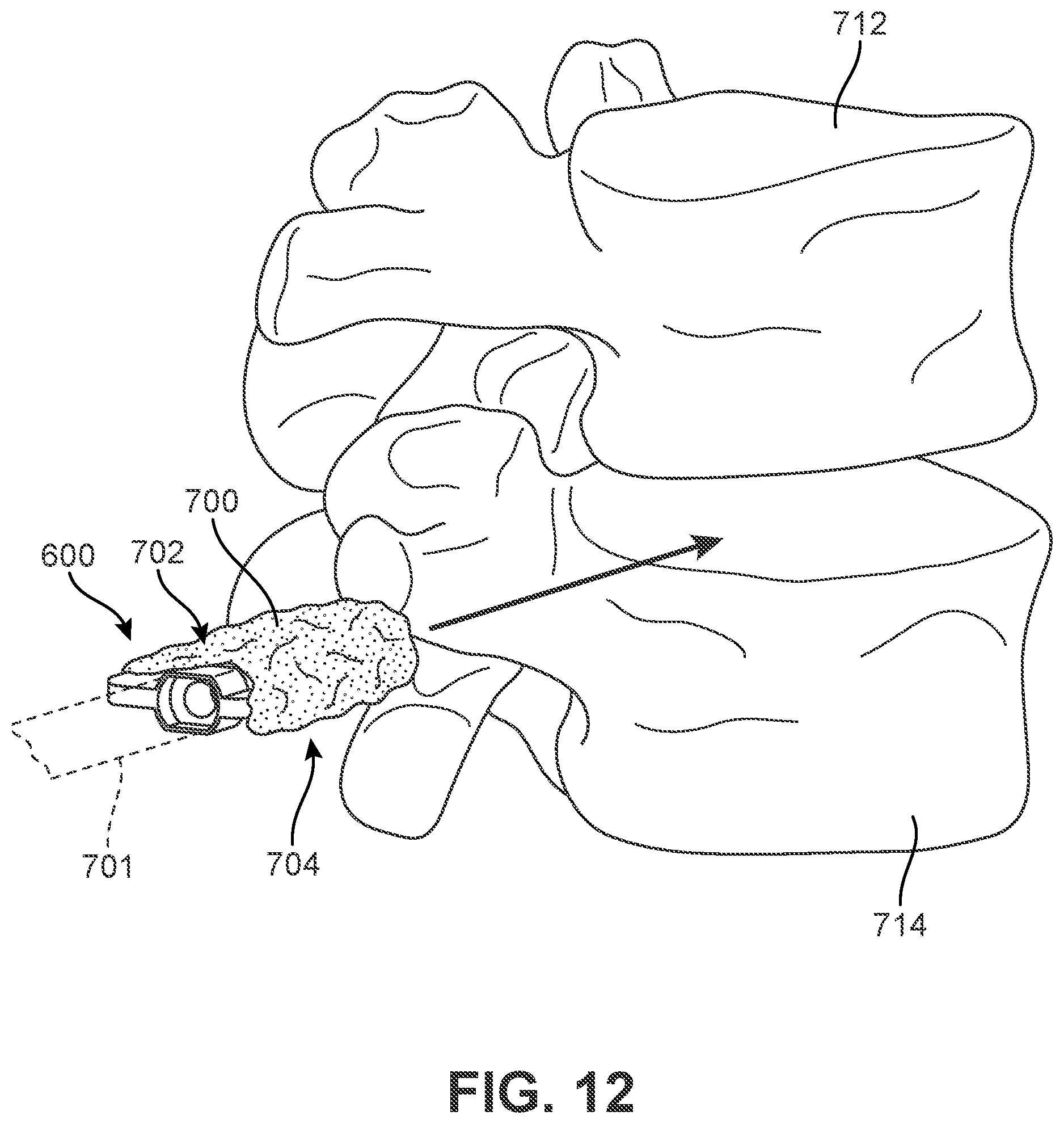 Patent US12303400 Figure 11 – Implant with structural members arranged around a ring
