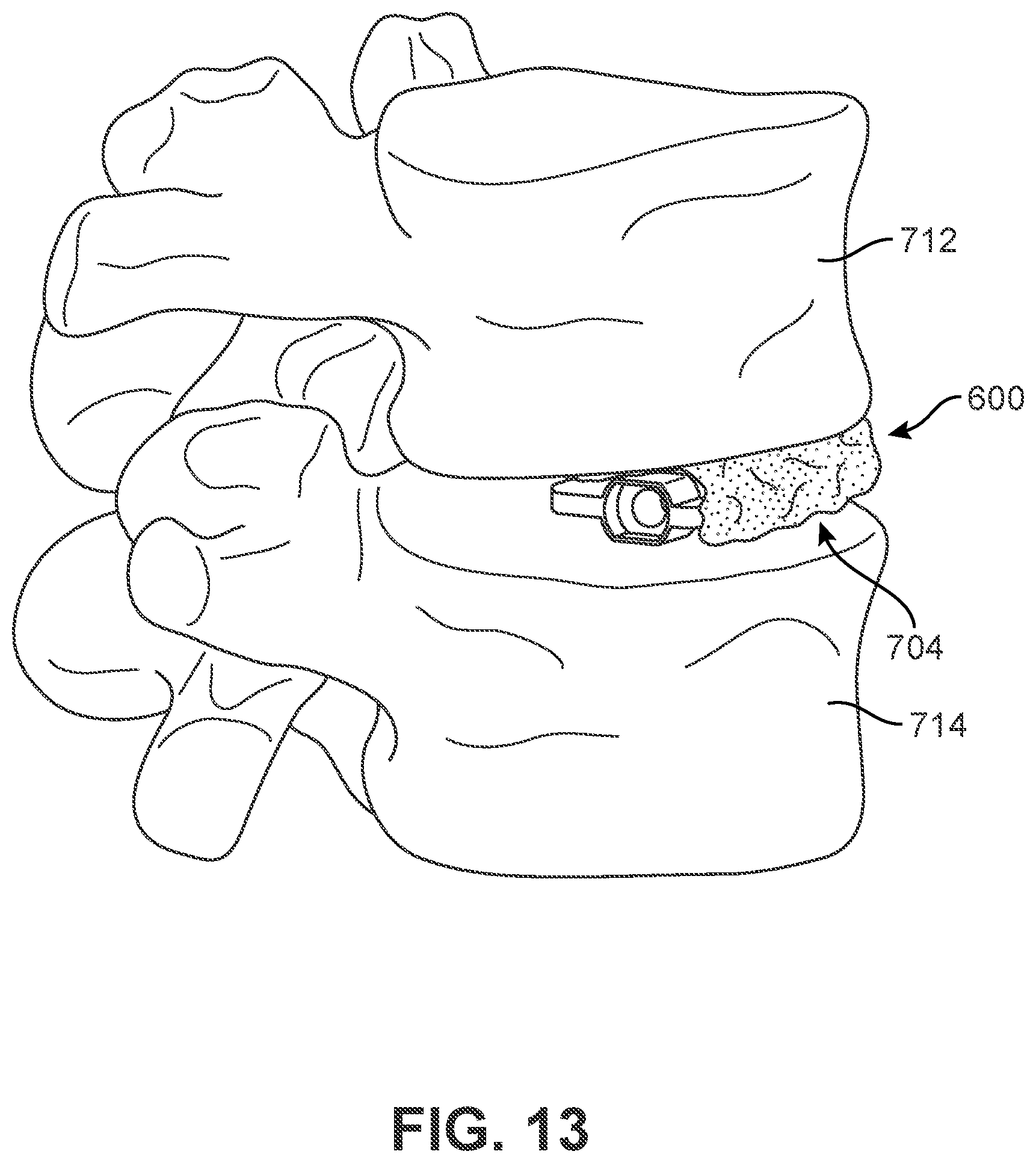 Patent US12303400 Figure 12 – Implant with structural members arranged around a ring