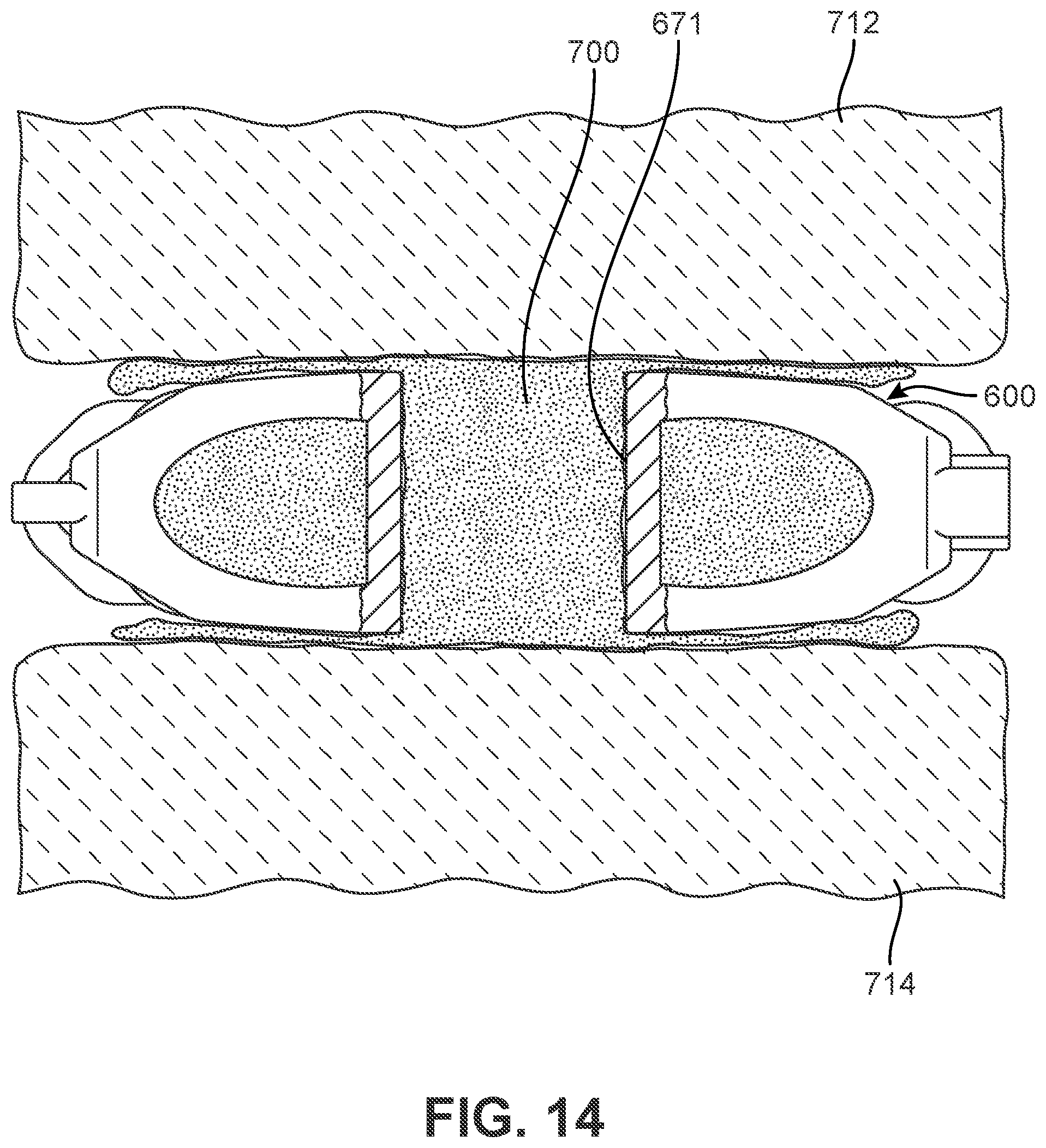 Patent US12303400 Figure 13 – Implant with structural members arranged around a ring