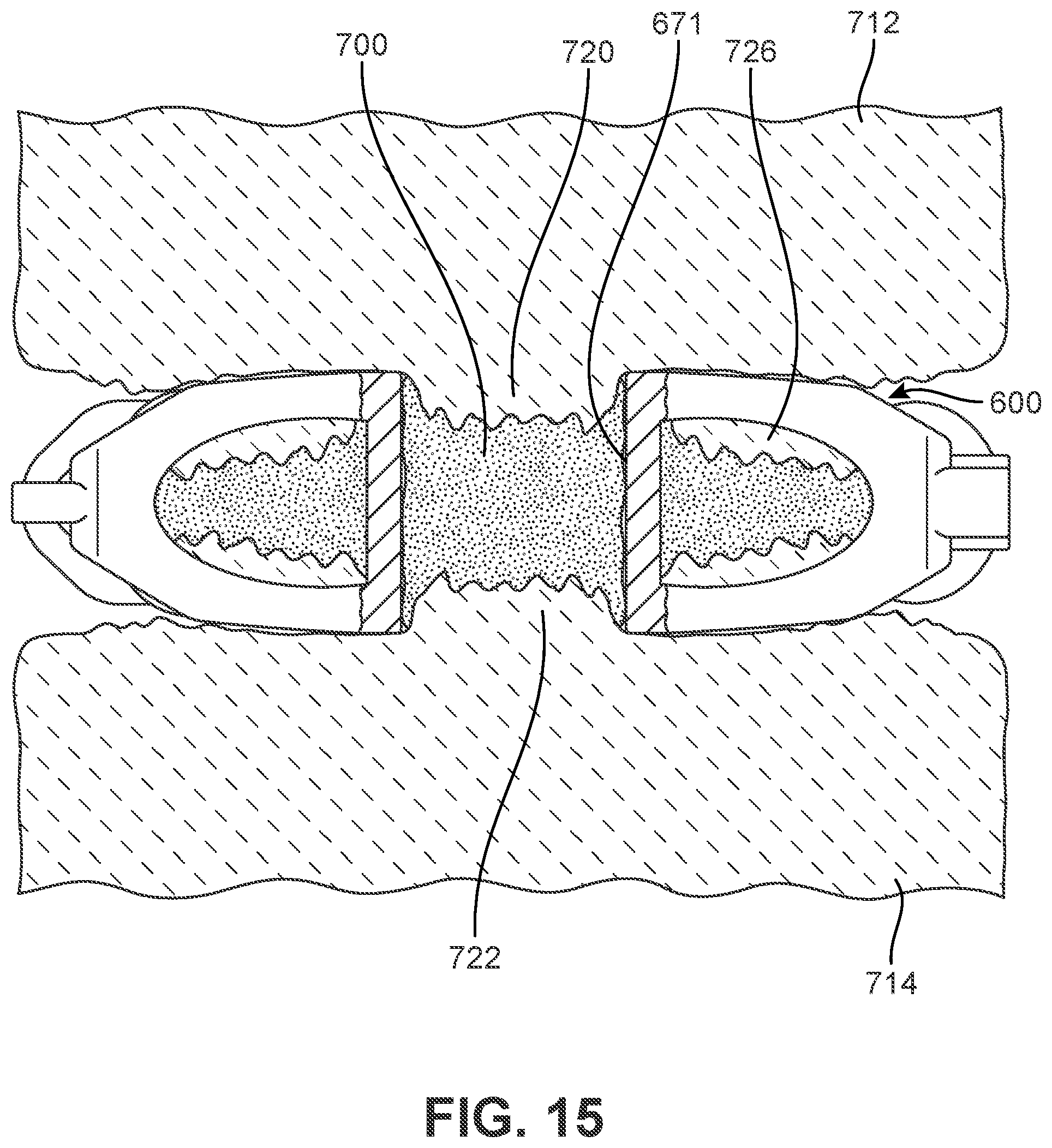Patent US12303400 Figure 14 – Implant with structural members arranged around a ring