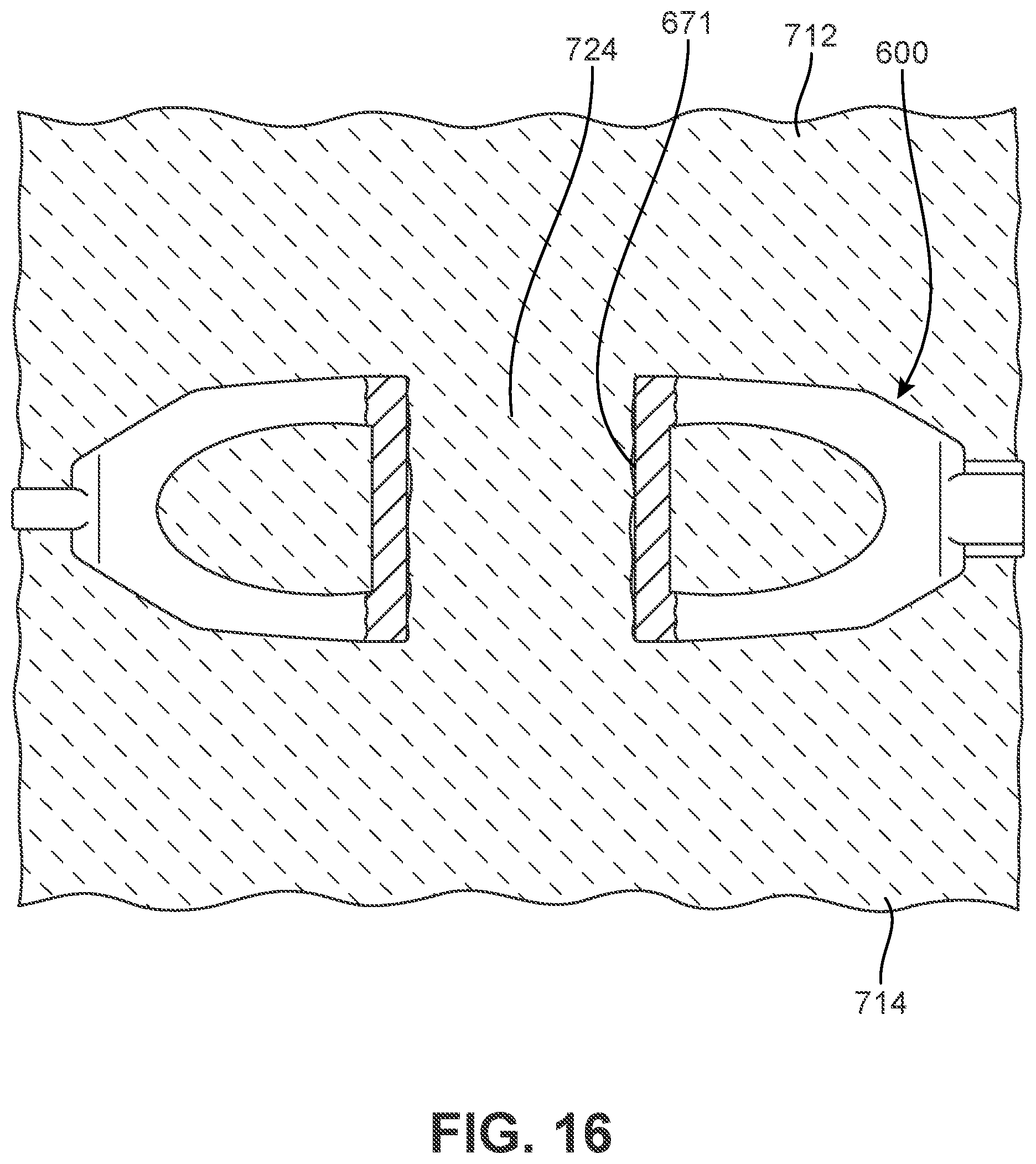Patent US12303400 Figure 15 – Implant with structural members arranged around a ring