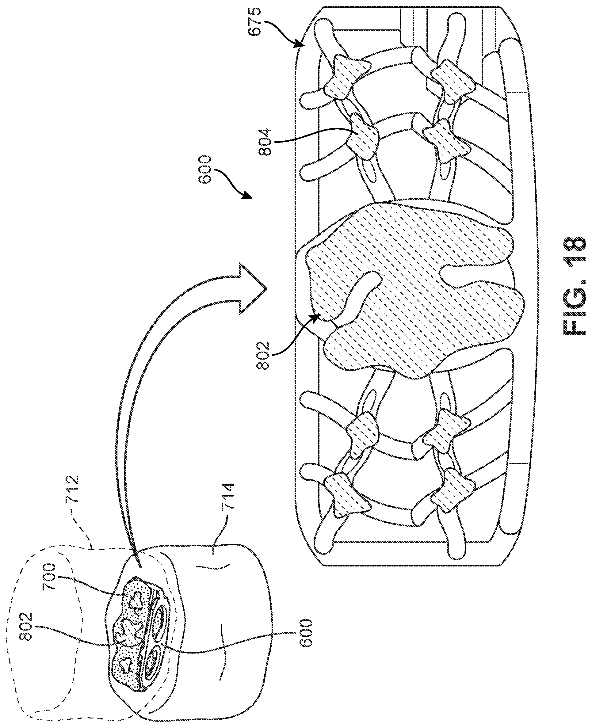Patent US12303400 Figure 17 – Implant with structural members arranged around a ring