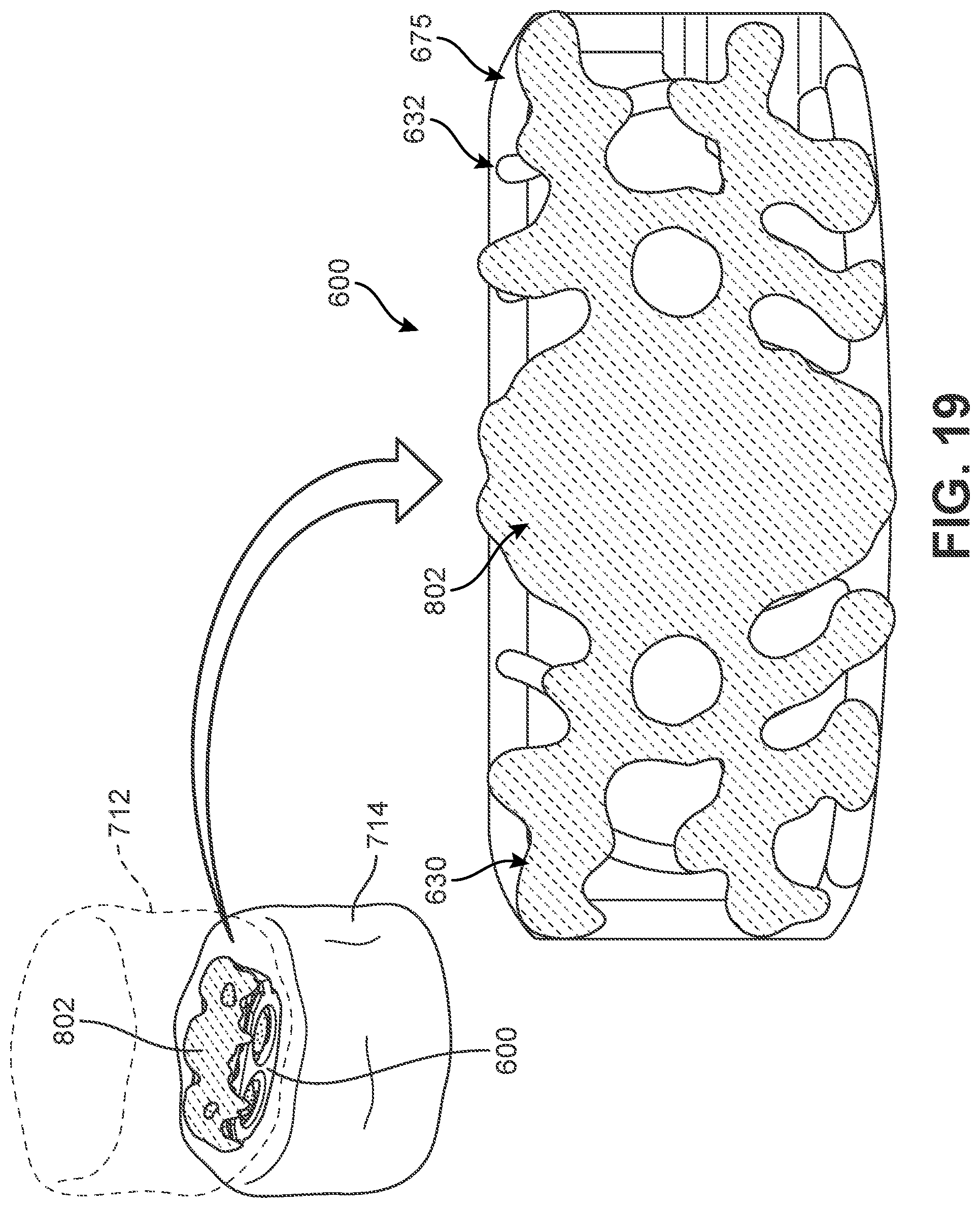 Patent US12303400 Figure 18 – Implant with structural members arranged around a ring
