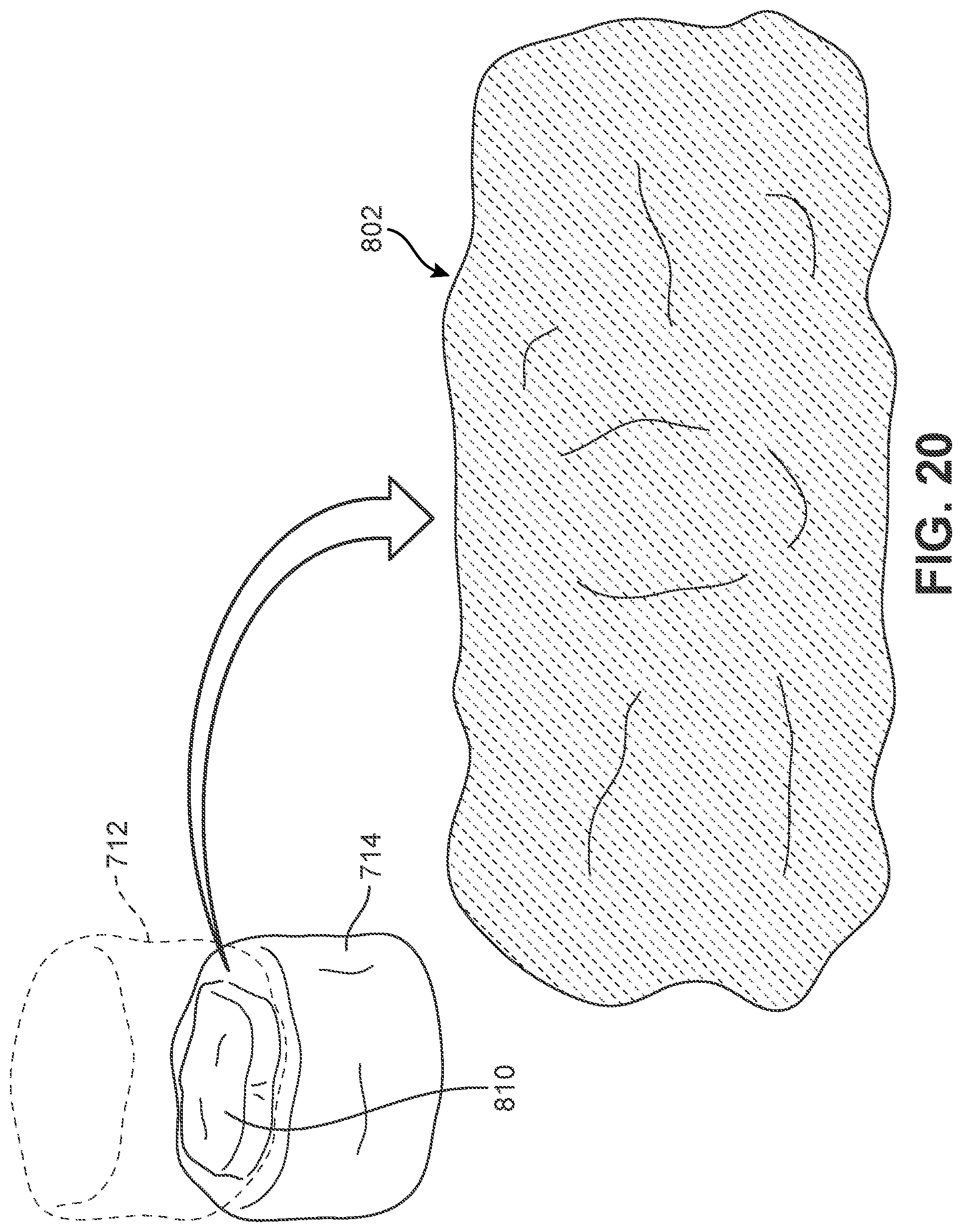 Patent US12303400 Figure 19 – Implant with structural members arranged around a ring
