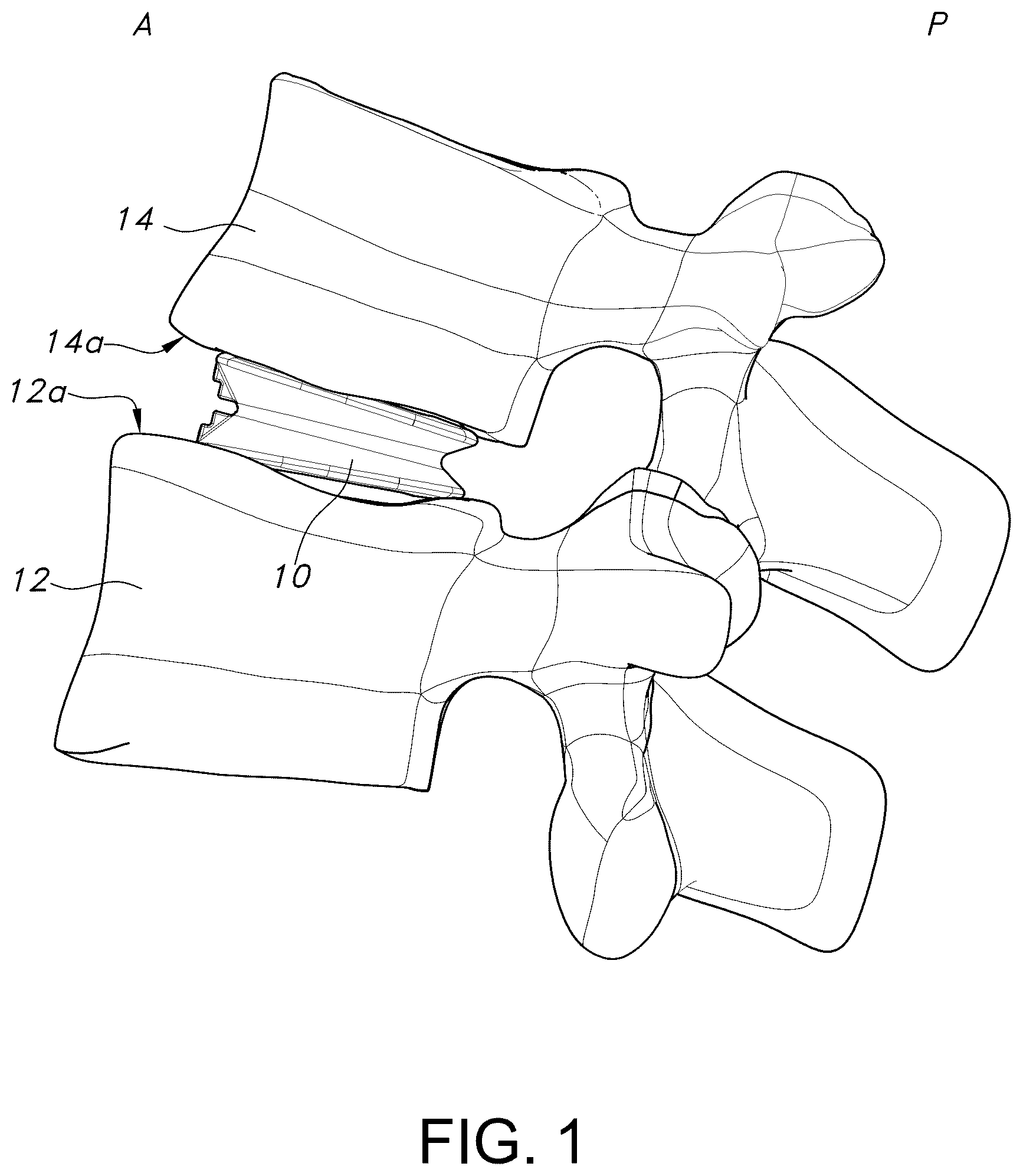 Patent US12303402 Figure 1 – Spinal interbody fusion device