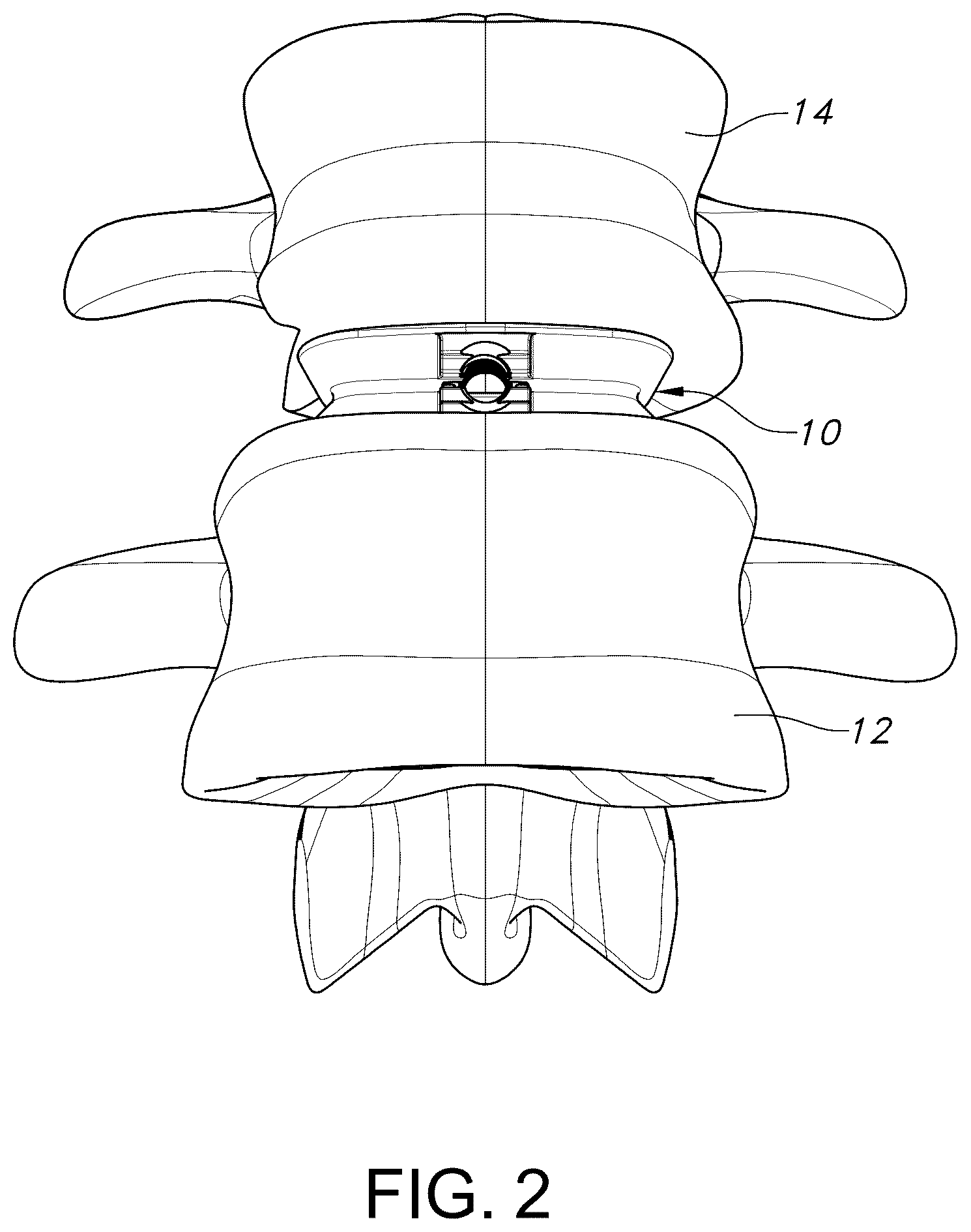 Patent US12303402 Figure 2 – Spinal interbody fusion device