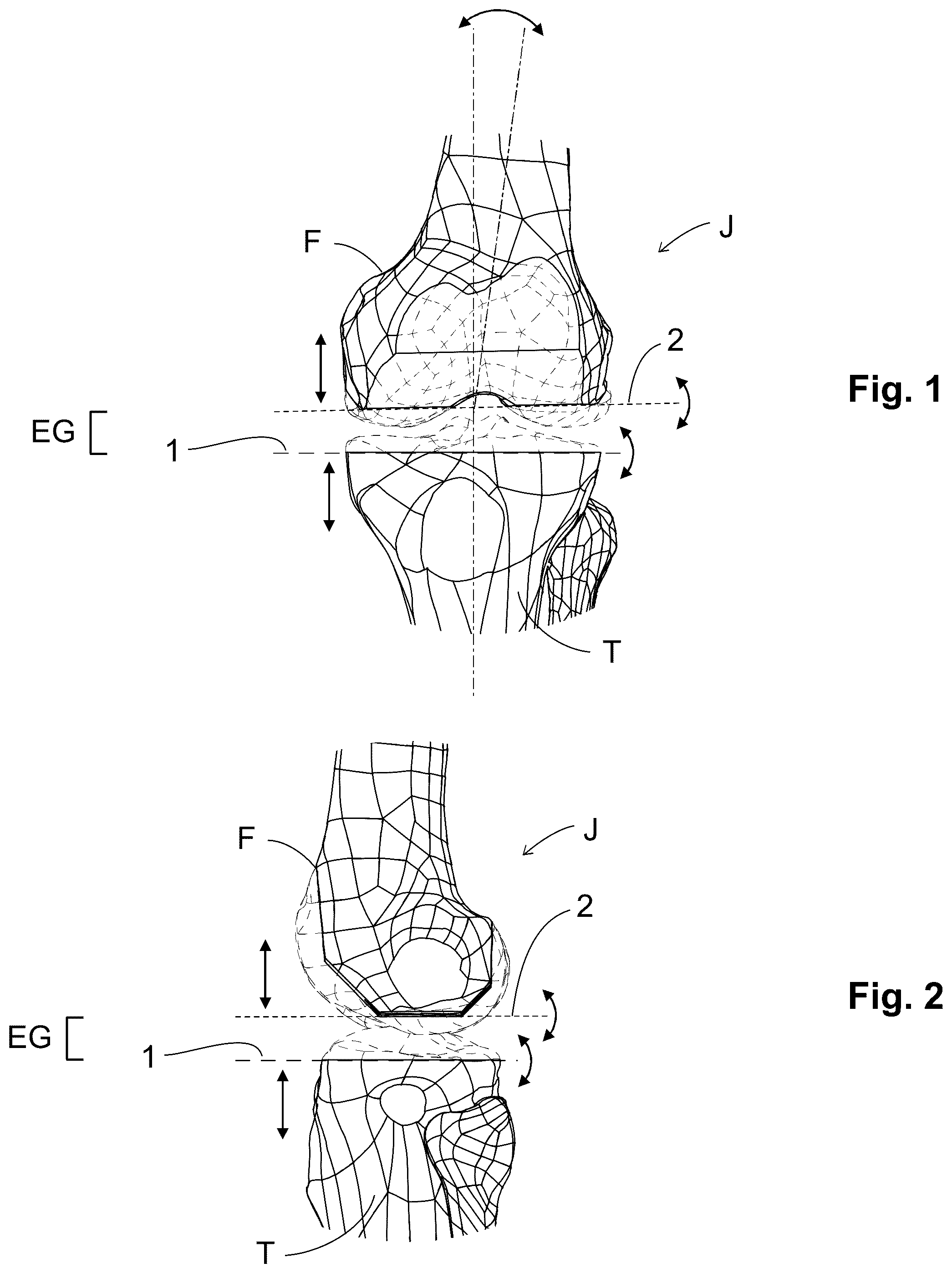 Patent US12303405 Figure 1 – Knee arthroplasty method